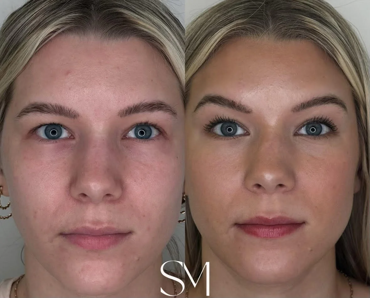 Before & Afters Witness Real Results — Sara Marie Facial Aesthetics
