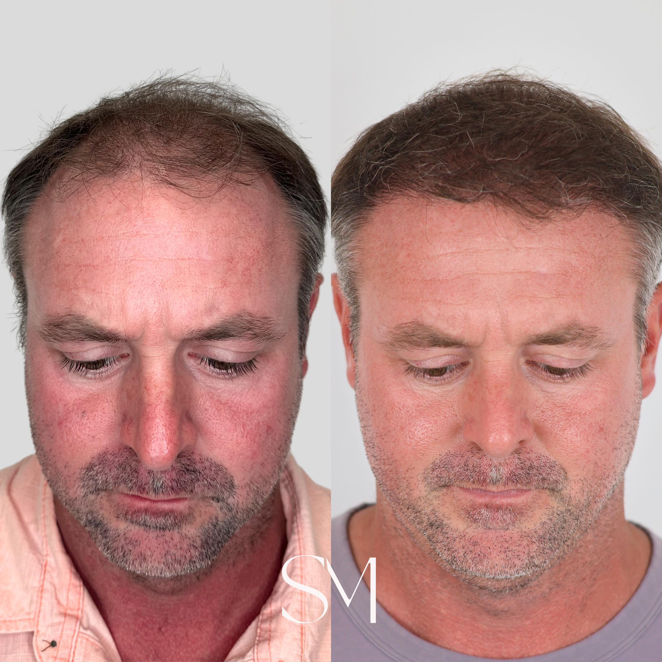 NeoGraft Hair Transplant