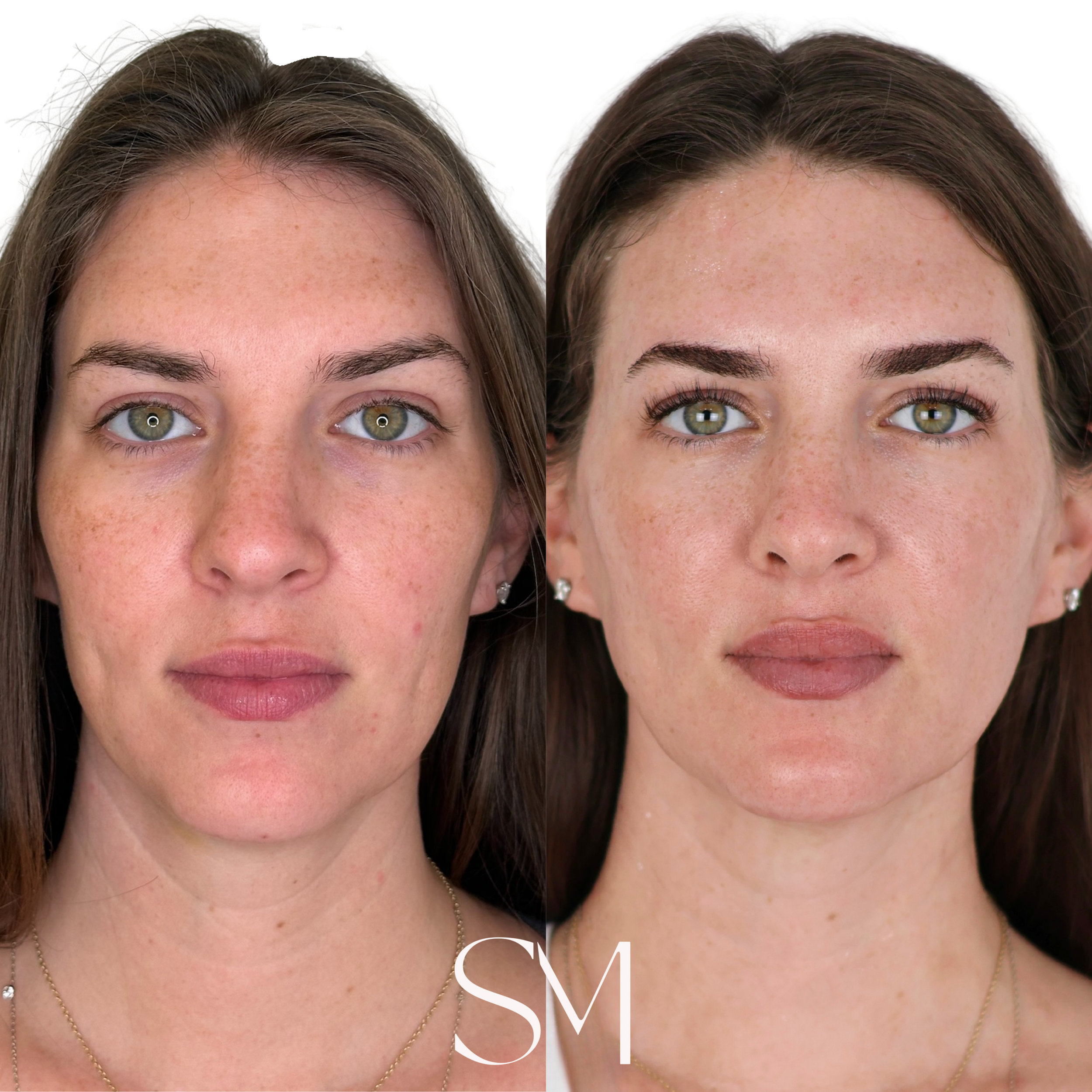 Two Year Transformation: Tox, Sculptra, Red Light Therapy mask & bed, NouvaDerm, SkinPen, IV Therapy, Peptides, PlaDuo, Aquafirme, Tixel, Lip Blushing, Korean Lash Lift, Peels, Medical grade skincare regimen