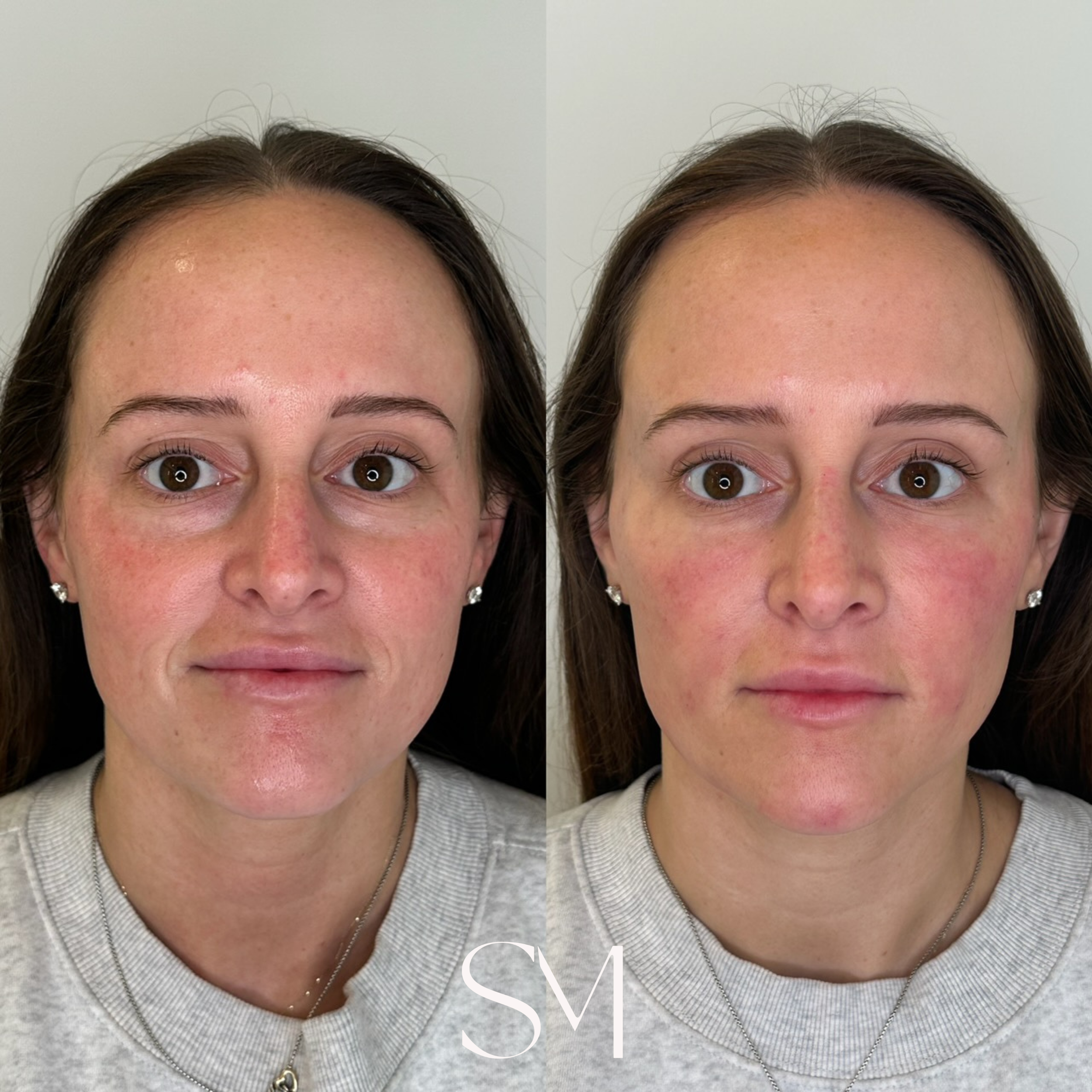 Full Face Derma PRP