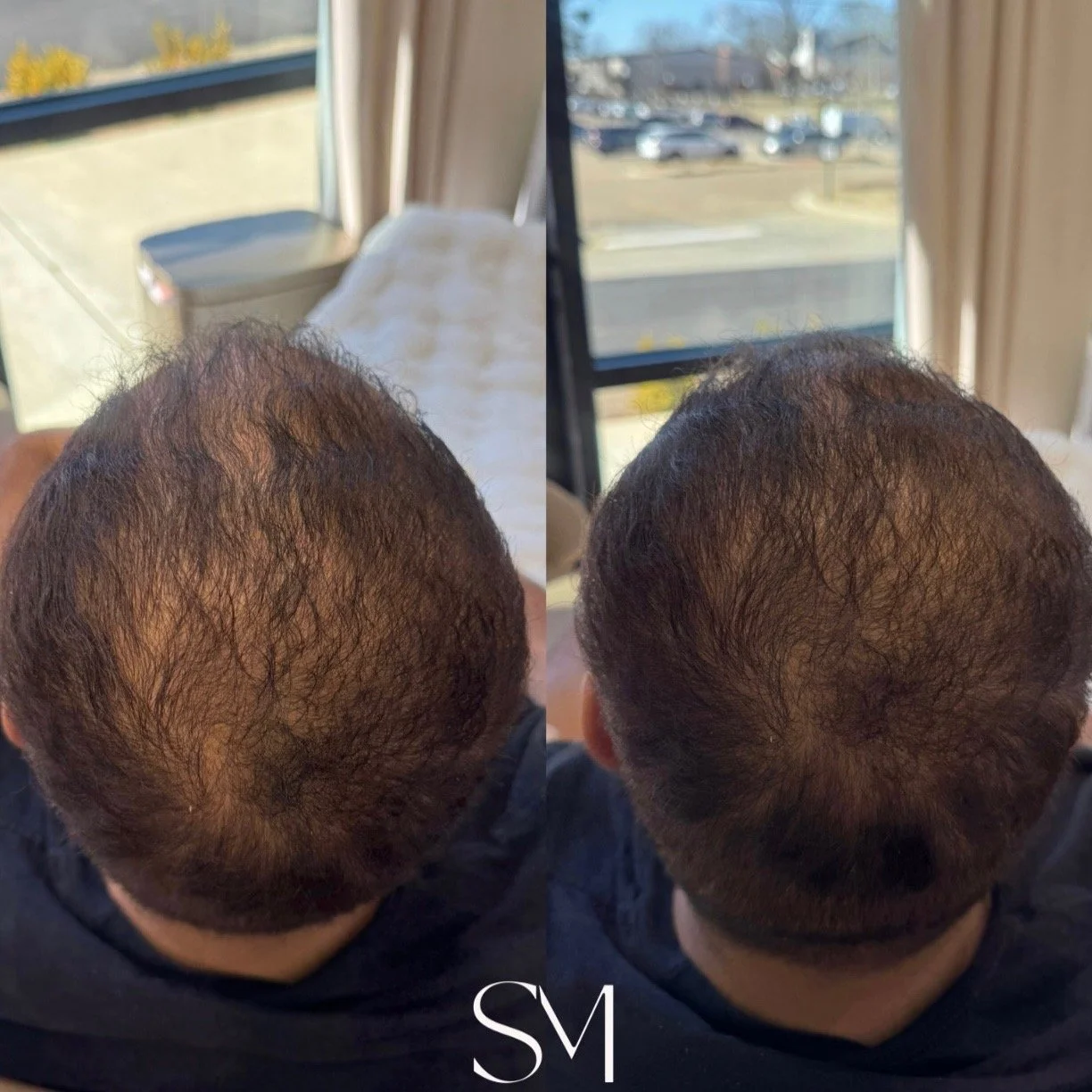 PRP Scalp Treatment - Two Sessions
