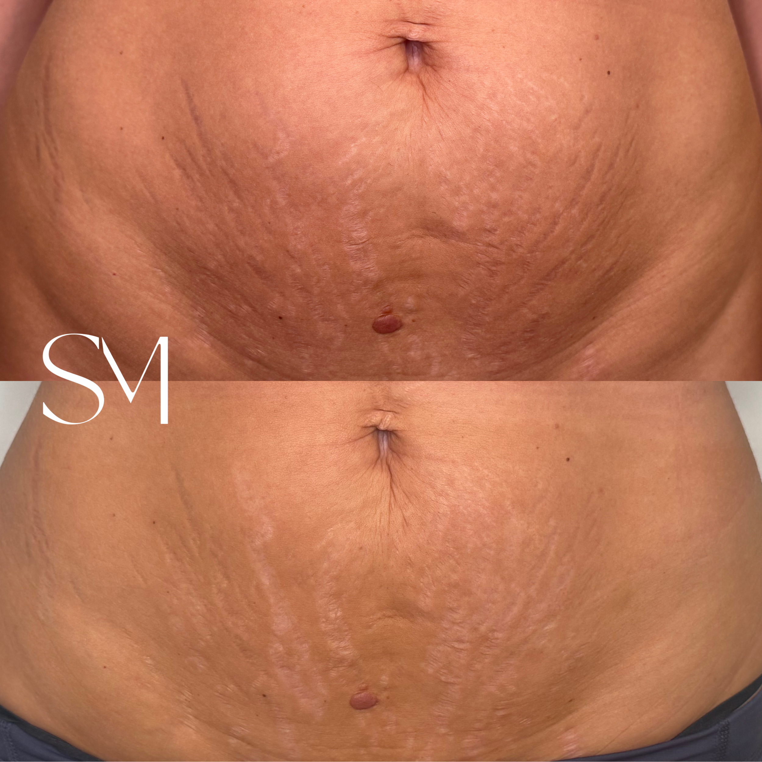 One NouvaDerm Treatment