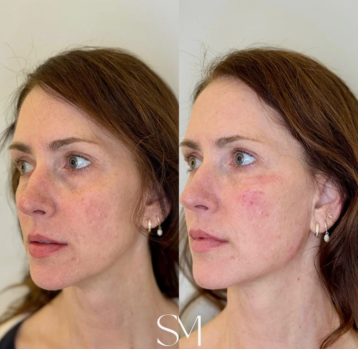 Derma PRP