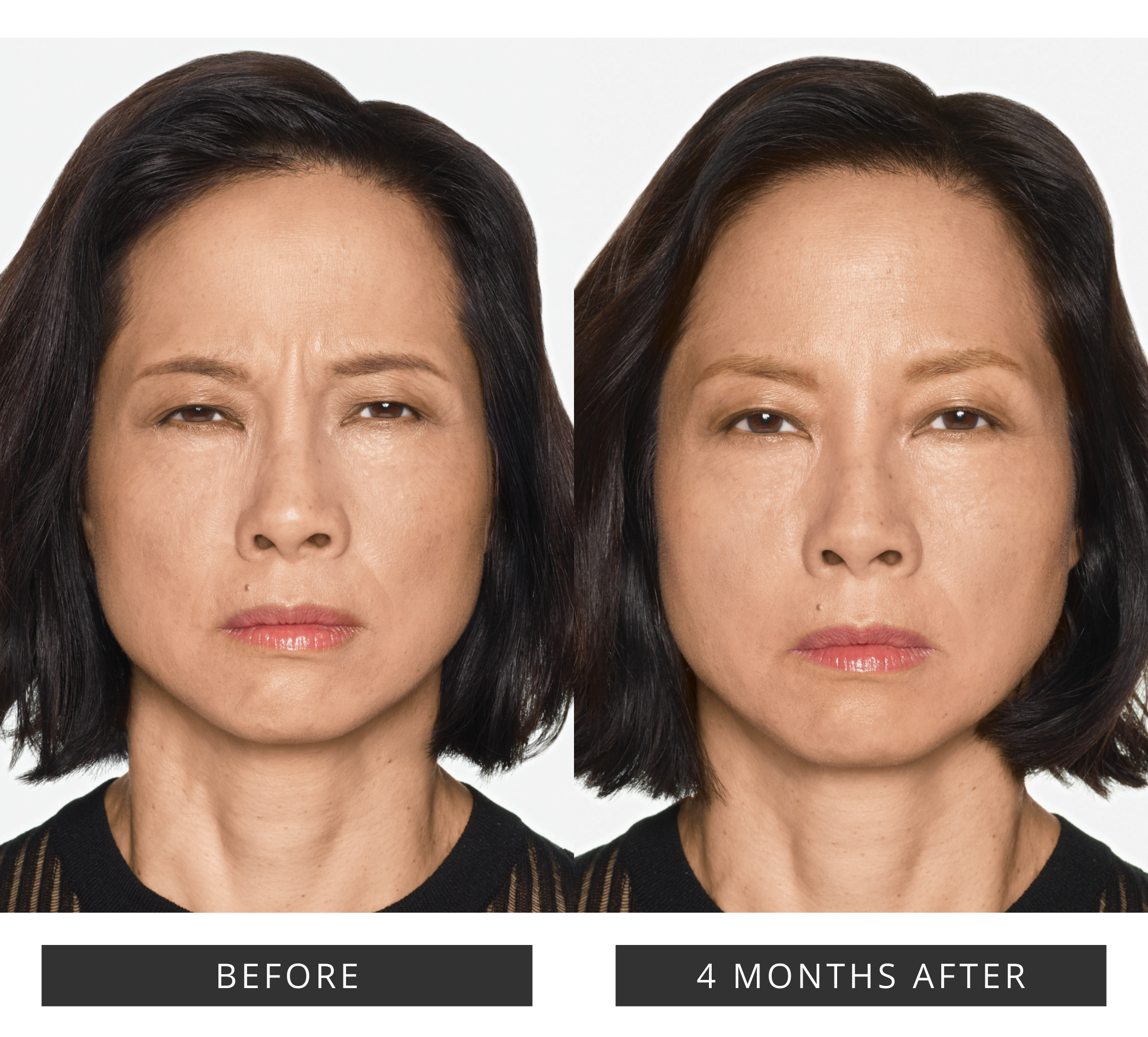 Daxxify in Bloomington Results.png