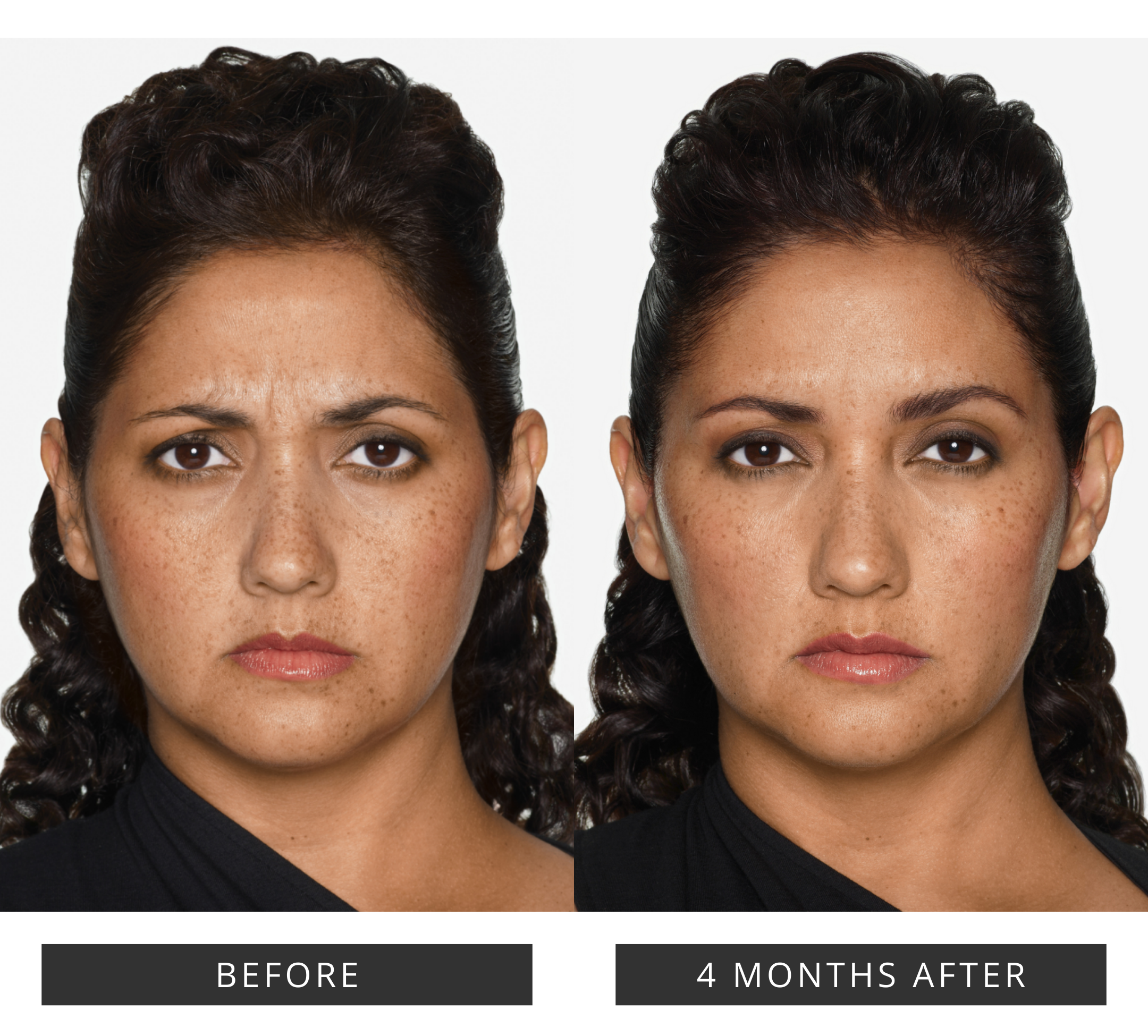 Daxxify in South Minneapolis Results.png