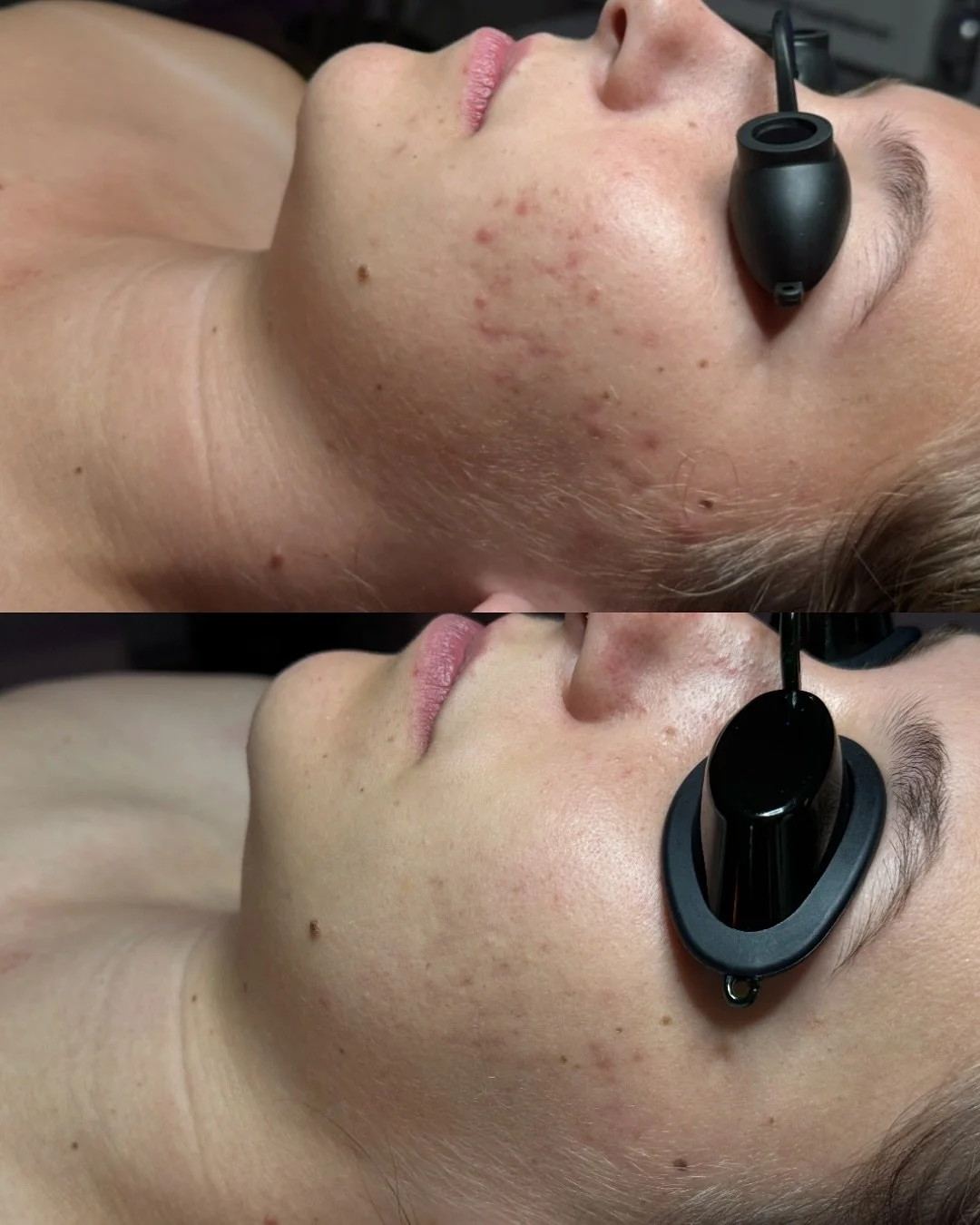 Loving the acne treatment results on my beautiful client. She has been consistently using Face Reality products and maintaining facials. Acne is totally cleared and we&rsquo;re working on the scaring 🙌🏻 Face Reality ✨ 
#facereality #acne #acnefree