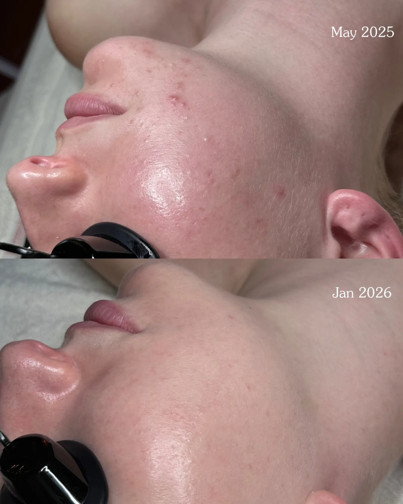 She is clear ✨ so proud of my beautiful clients transformation 🥰 

#acnefreeskin #facereality #acnetransformation #acnetreatmentla