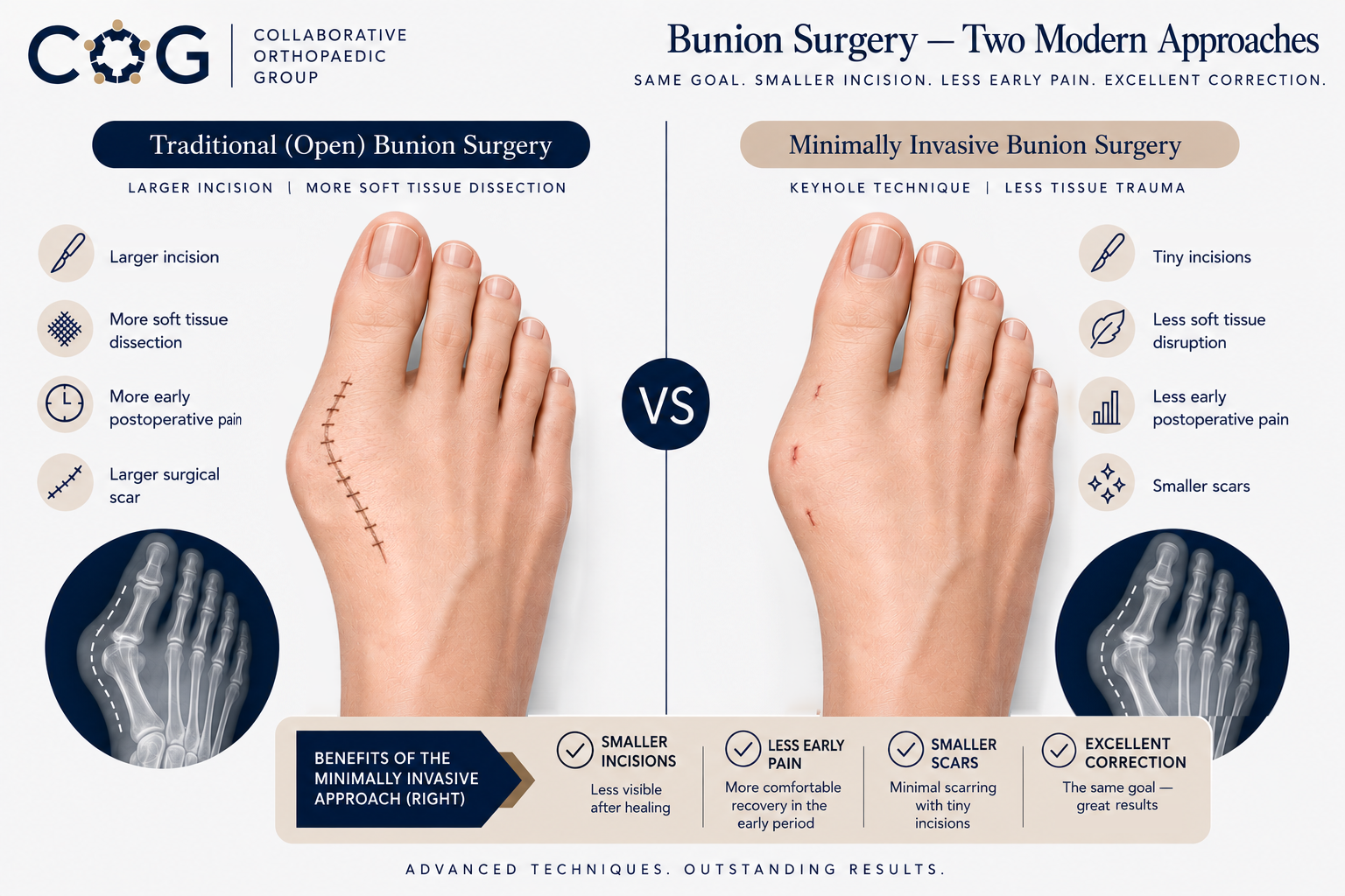 Is Minimally Invasive (Keyhole) Foot Surgery as Effective as Open Surgery?