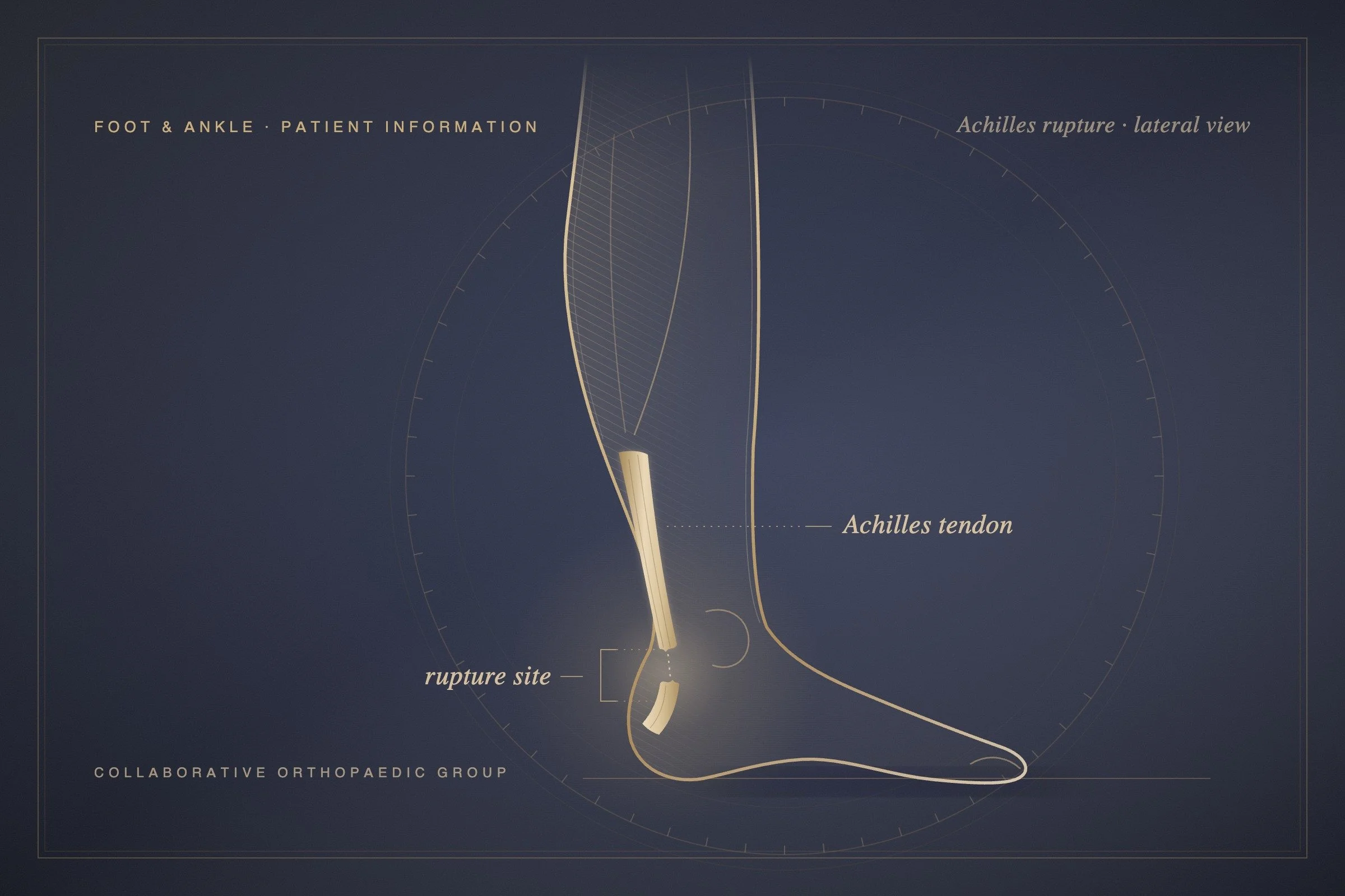 Can you still walk on a ruptured Achilles?