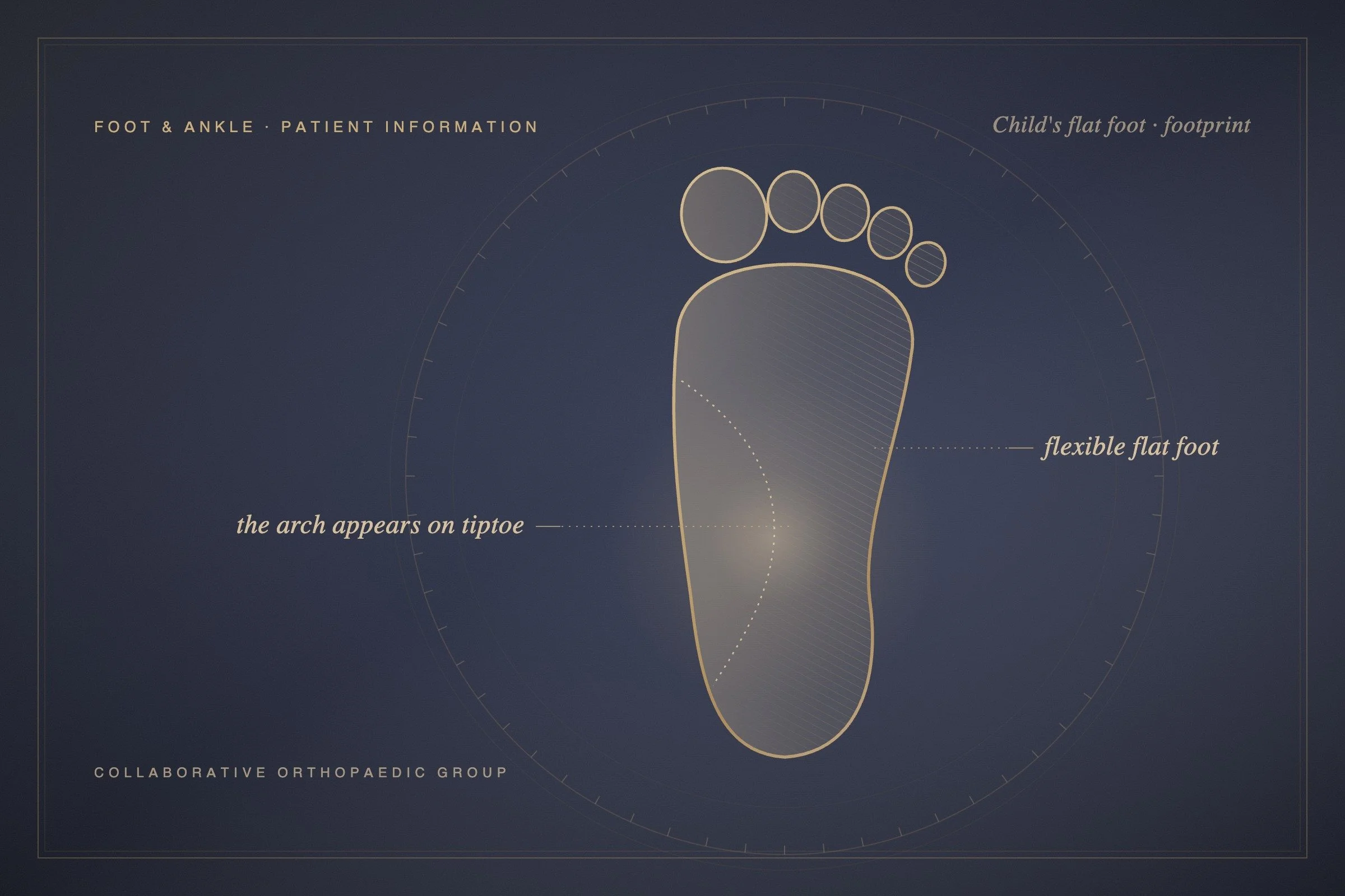 Does my child need orthotics for flat feet?