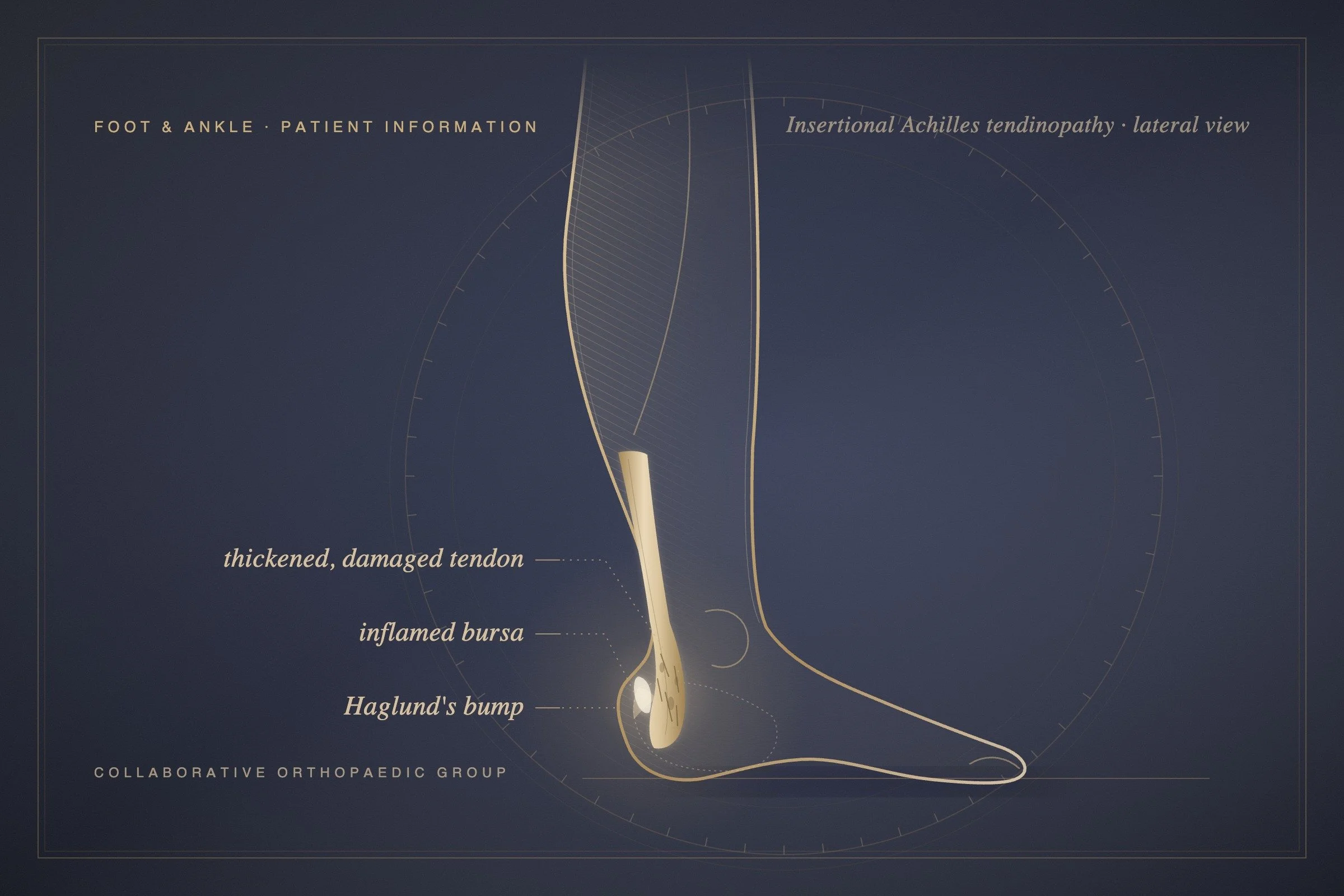 Why is my Achilles still sore after months of rest?