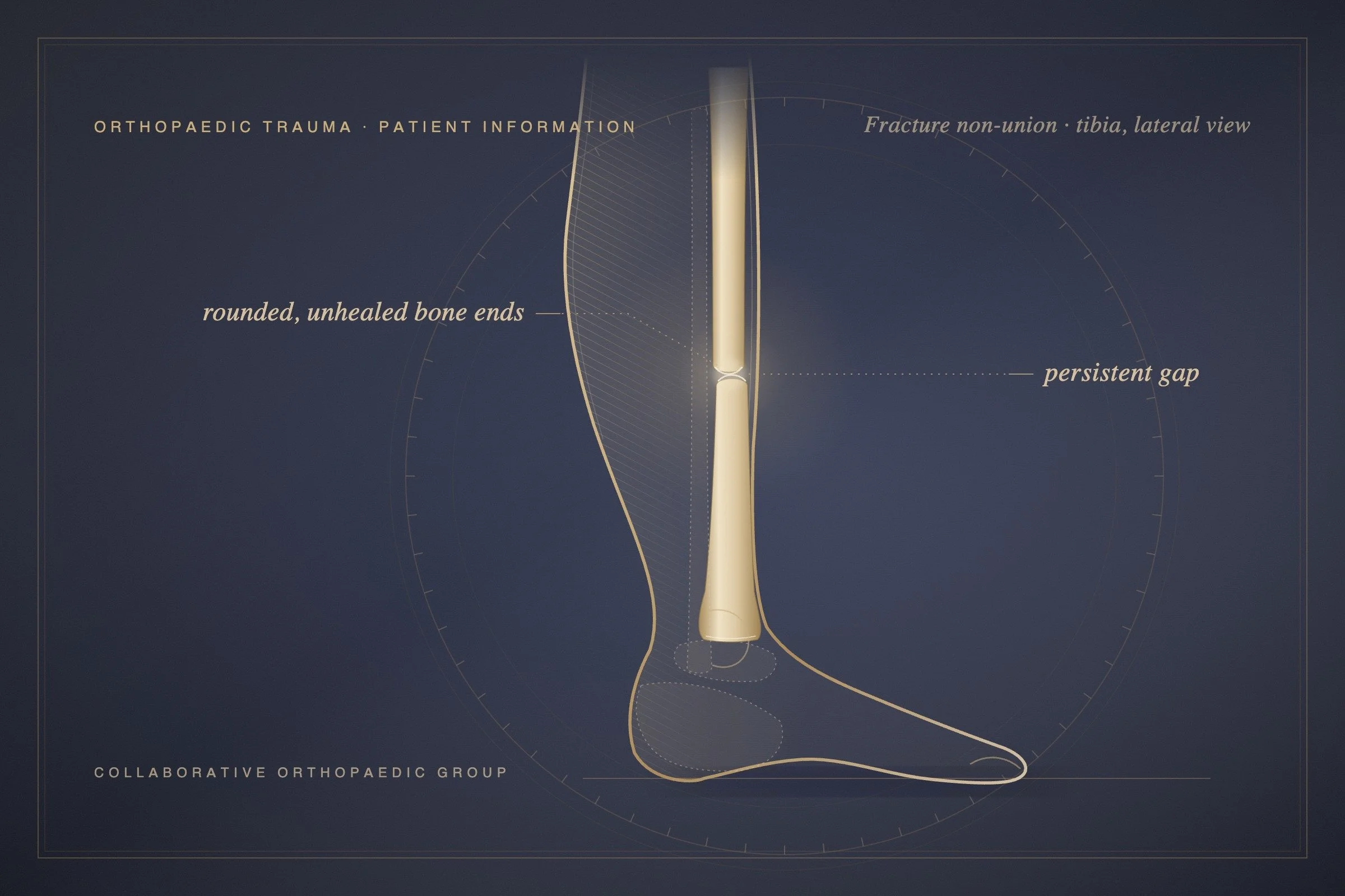 What Are the Warning Signs a Fracture Isn't Healing Properly?