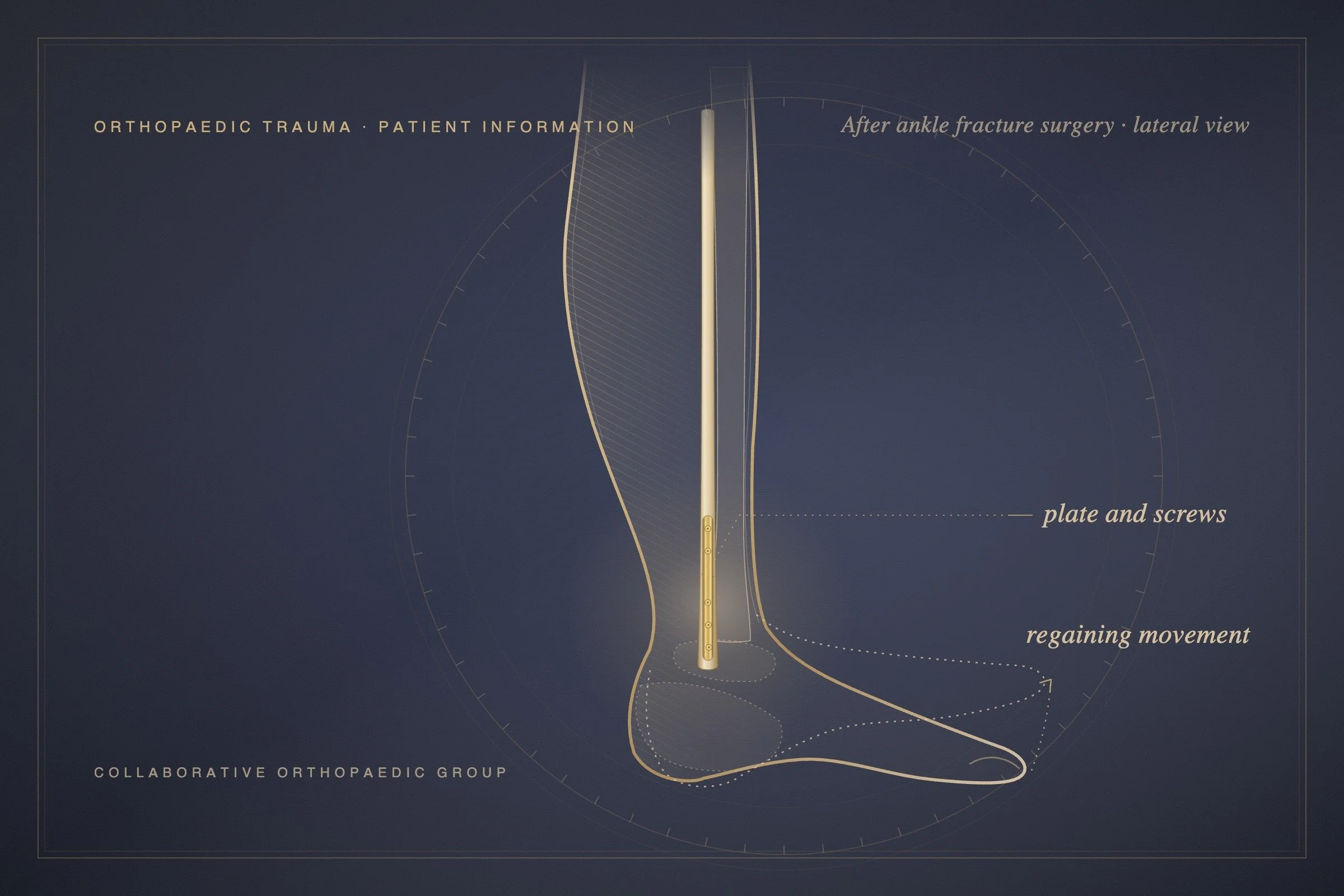 Will I Need Physiotherapy After Fracture Surgery?