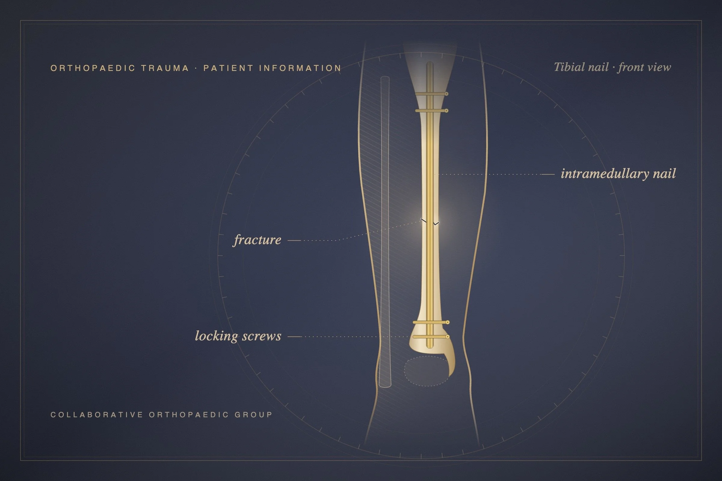 What's Involved in Surgery for a Broken Leg?