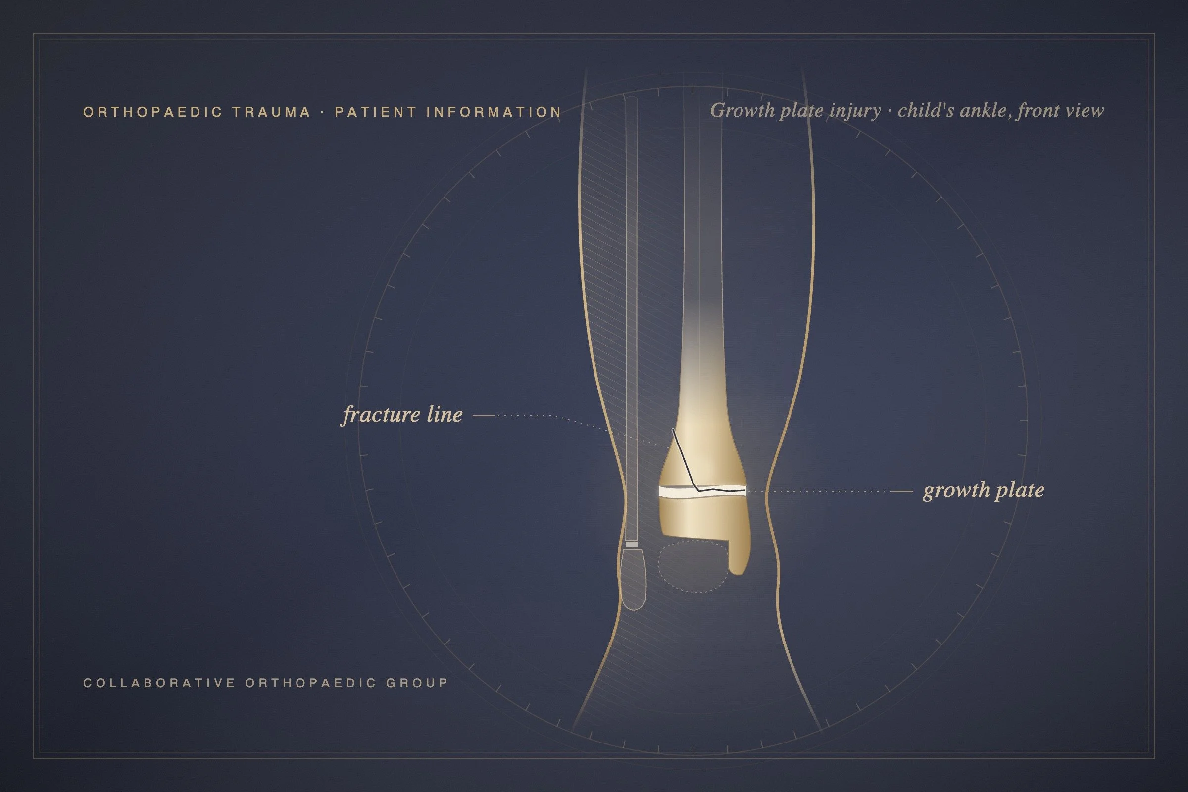 When Can My Child Return to Sport After a Growth Plate Injury?