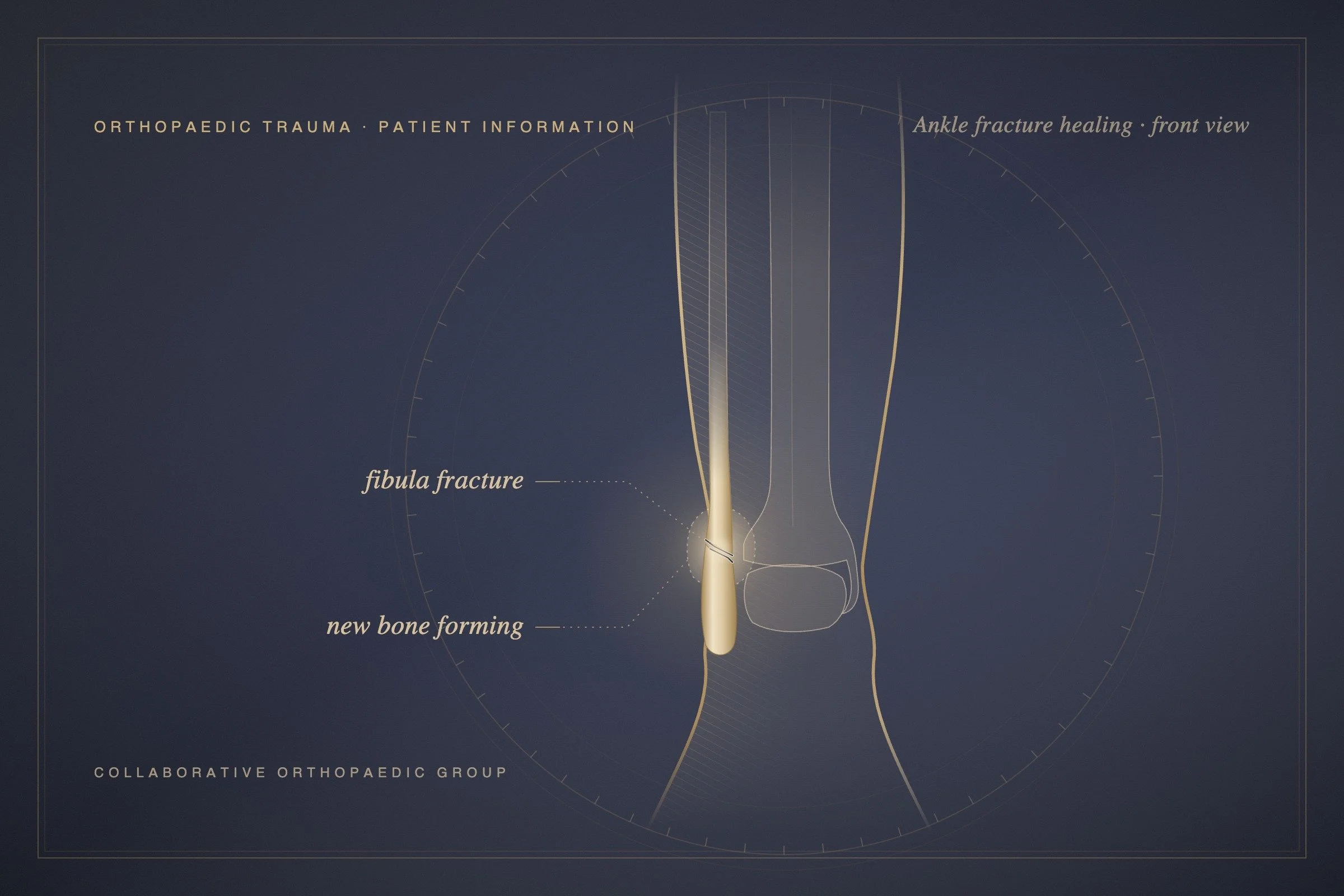 How Long Does It Take for a Broken Ankle to Heal?