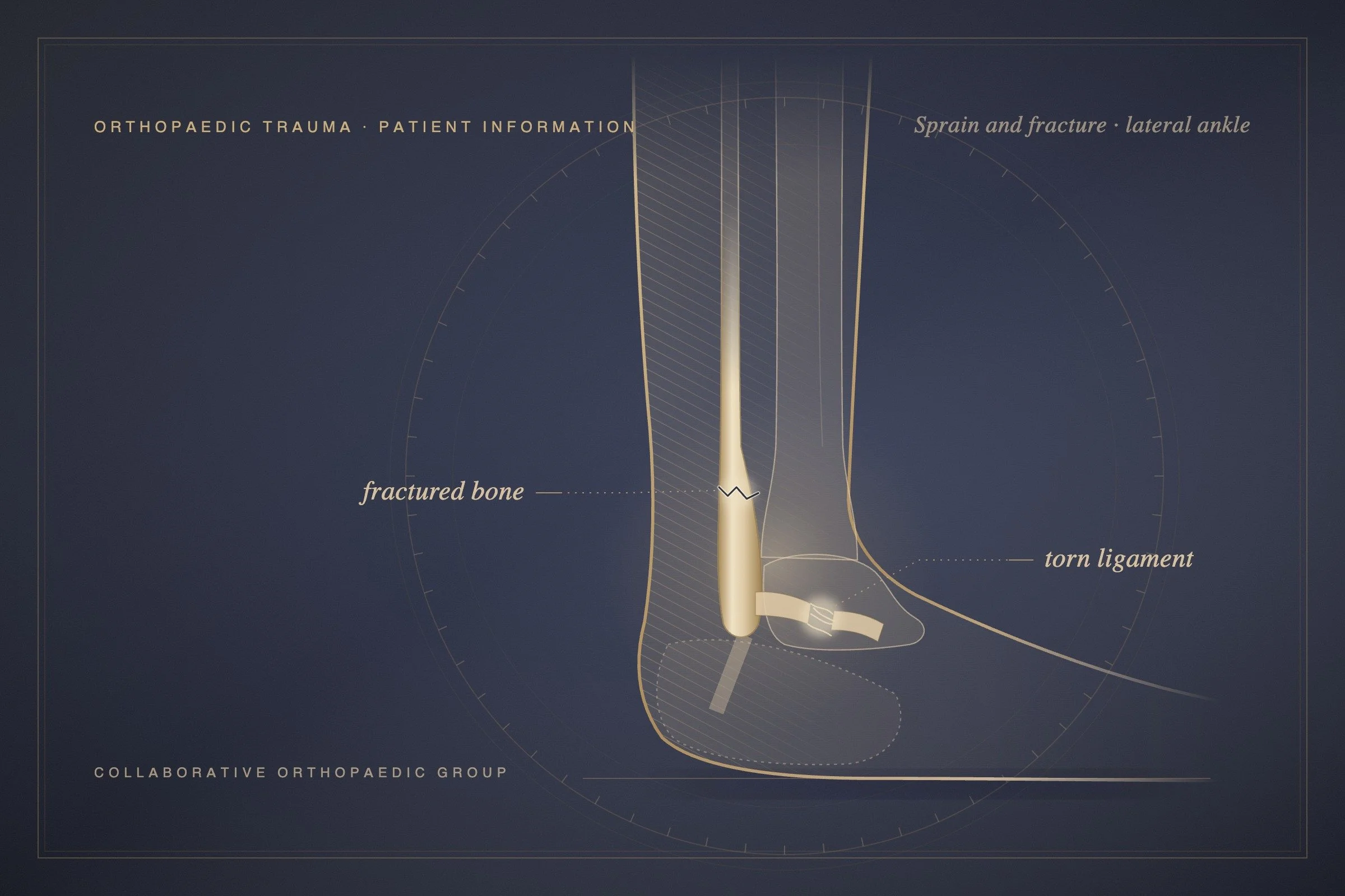 What’s the Difference Between a Sprain and a Fracture?