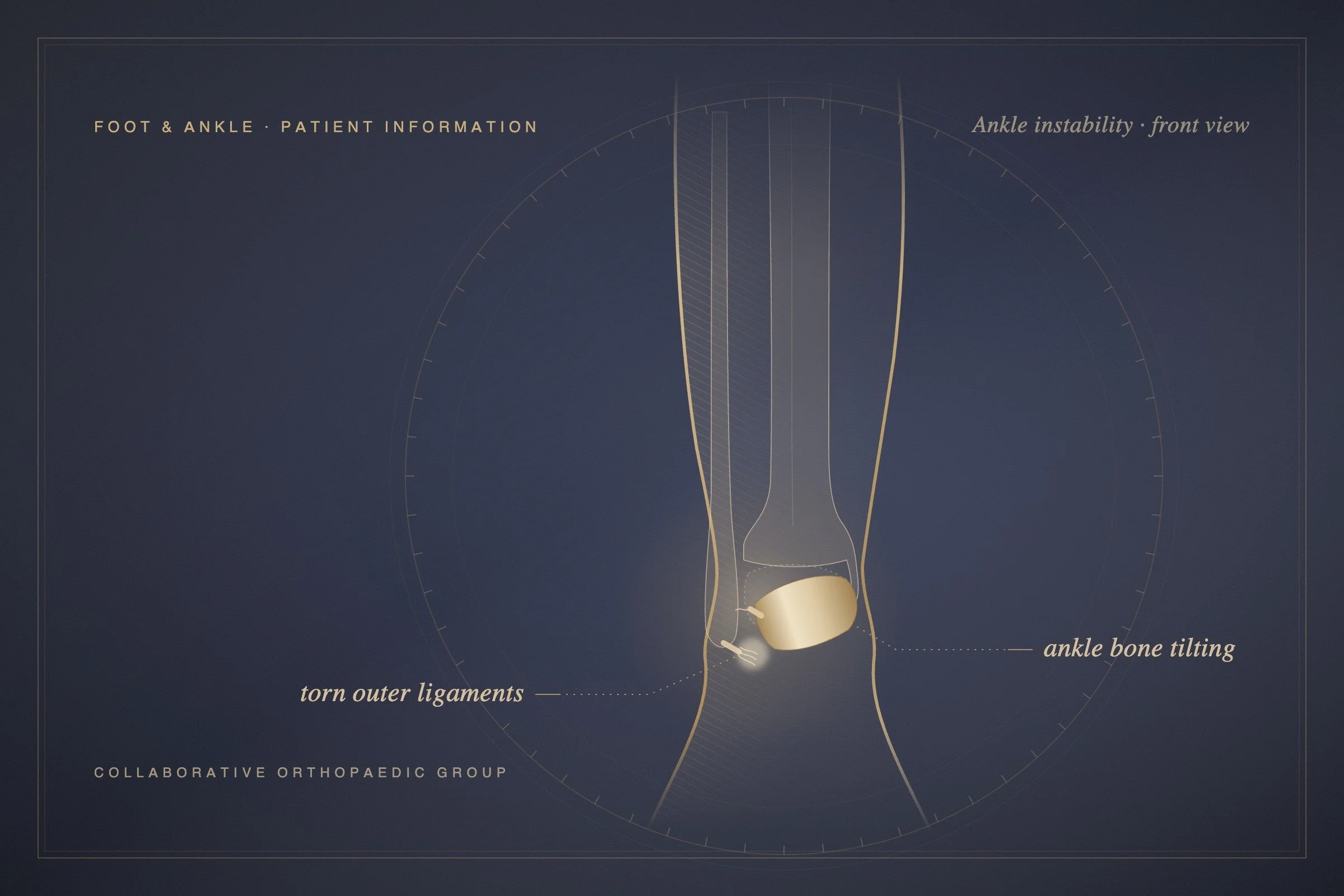 What Causes Ankle Instability, and When Does It Need Surgery?