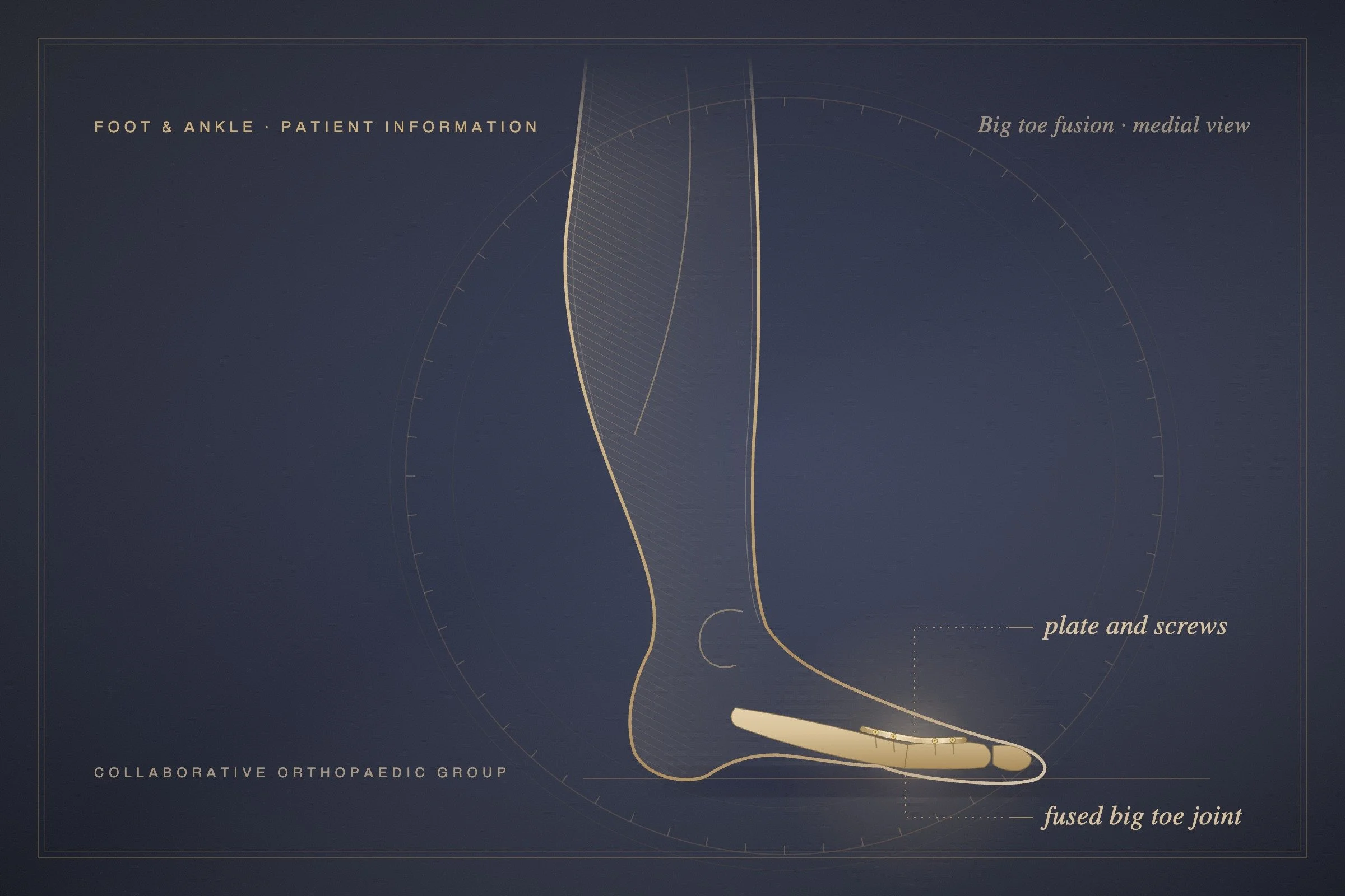 Will I walk normally after a big toe fusion?