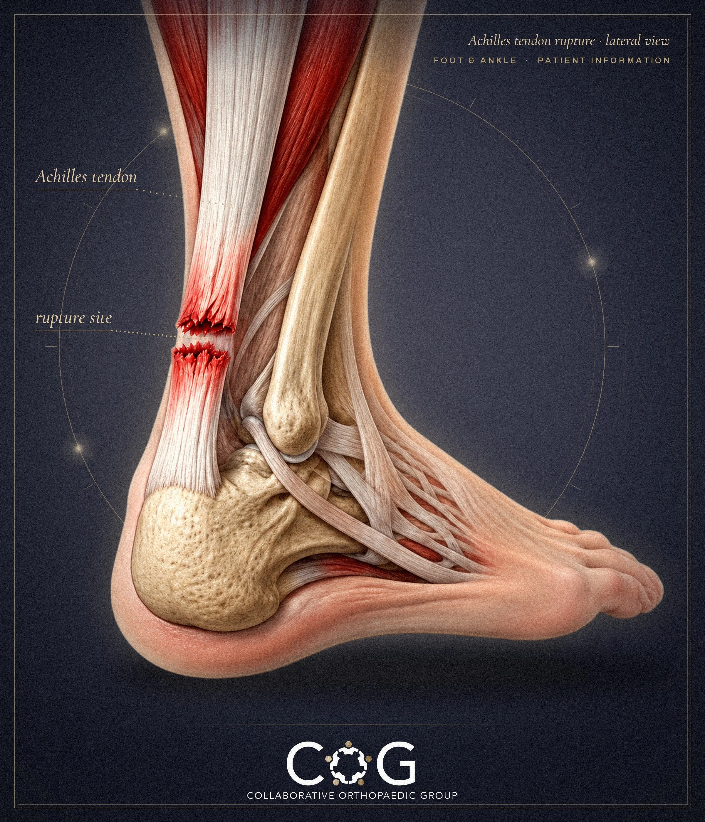 Achilles Rupture Melbourne