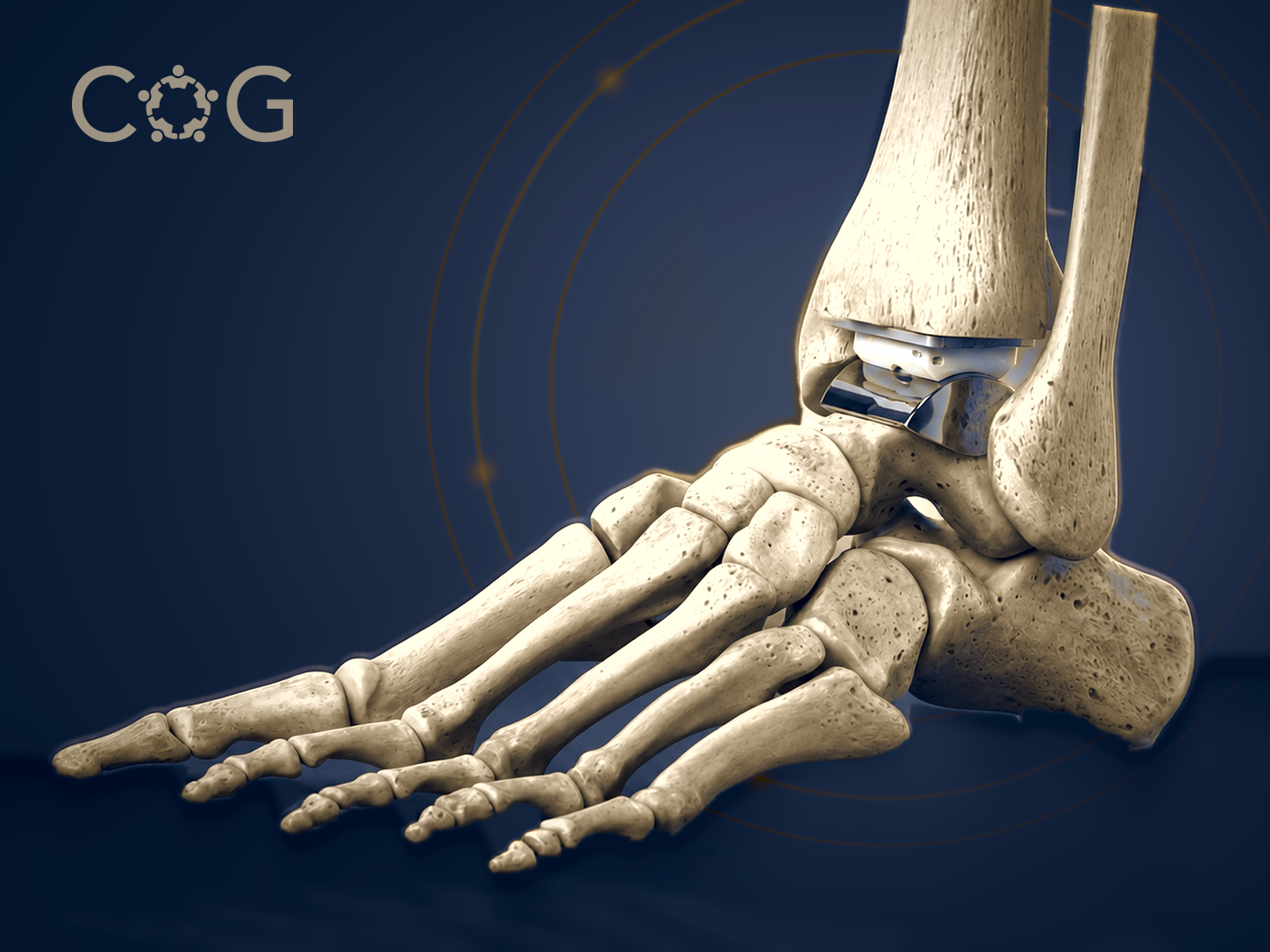 Ankle Replacement Melbourne
