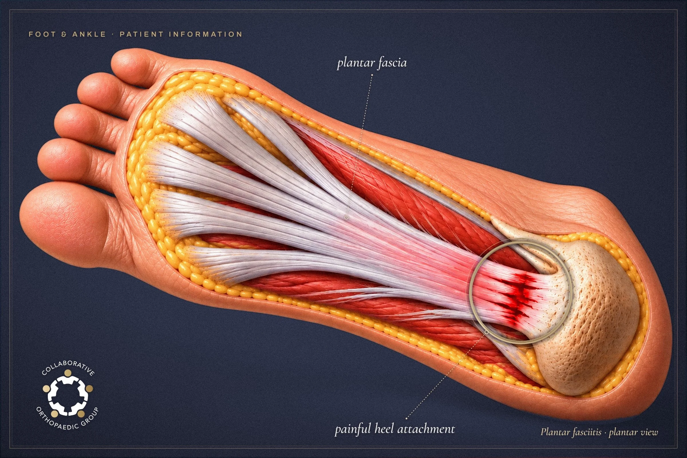 Plantar Fasciitis Melbourne