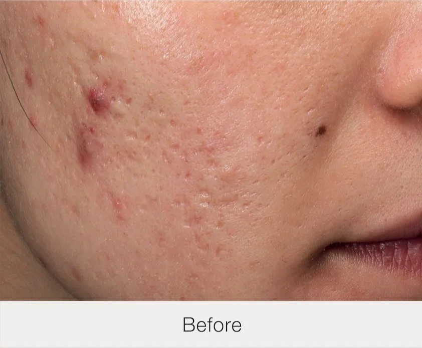 Close-up of a person's cheek with acne and scarring, labeled "Before."