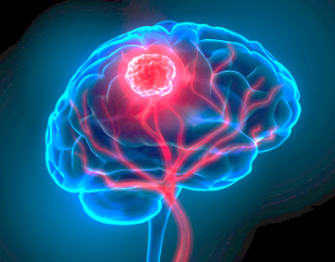 CAR-T Cell therapy in CNS malignancies and metastatic disease: a quick overview of toxicity profiles and efficacy signals