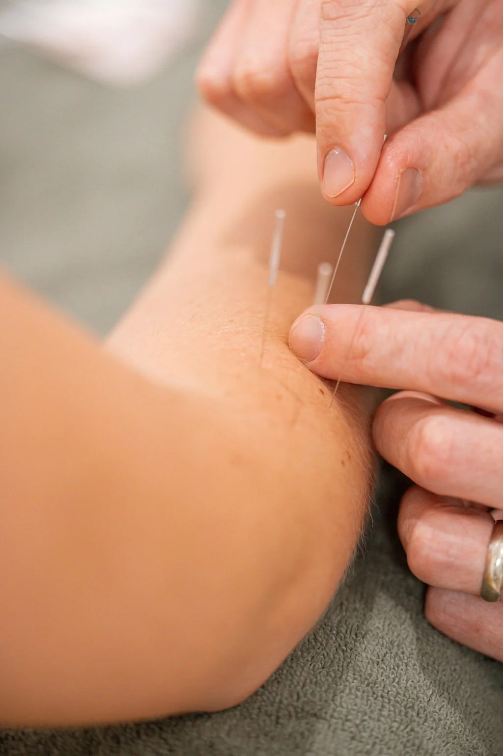 Person receiving acupuncture treatment with thin needles inserted into their skin.
