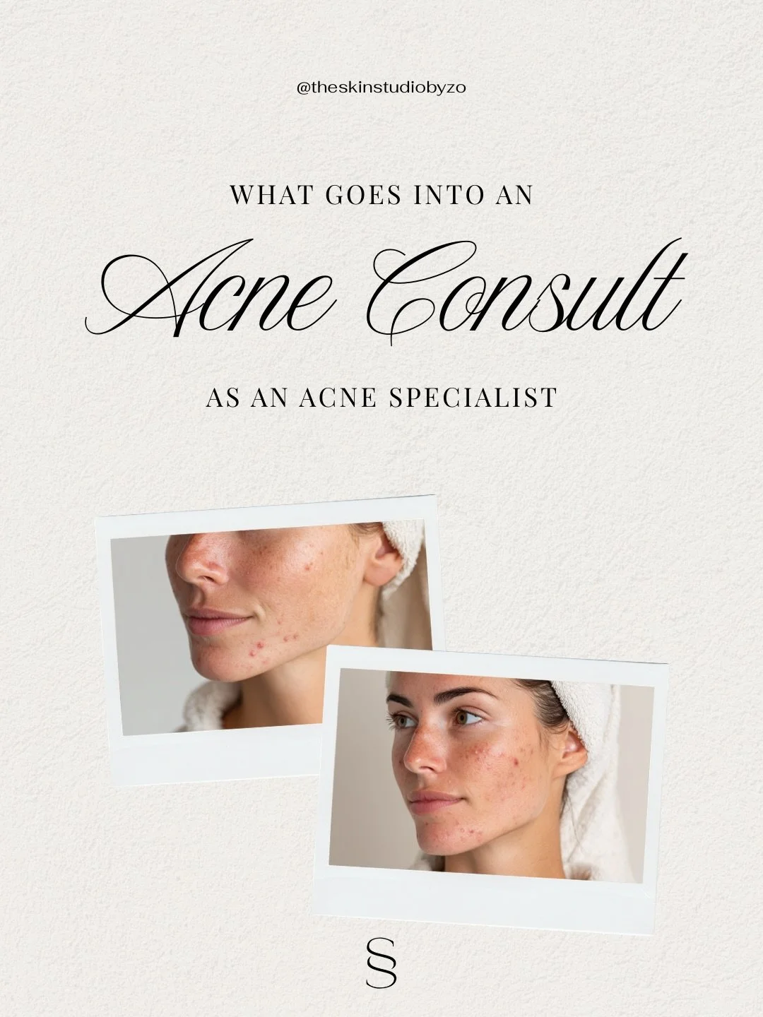 What do I look for during an acne consultation? Everything. 🤓 

Acne isn&rsquo;t just surface level, and you deserve more than a &ldquo;one-size-fits-all&rdquo; cream.. I look at your skin story&mdash;from your cycle and stress levels to your skin b