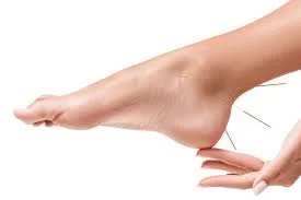 Clinical Study acupuncture and foot surgery hallux valgus by Dr Phan Thi Thanh Nhan