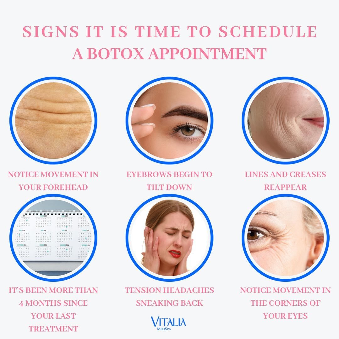 Keeping a consistent schedule with your Botulinum toxin can help to minimize fluctuations in your appearance and ensures fewer and less deep wrinkles in the long run. 

Hot girls never miss a botox appointment 🤪

#antiaging #selfcare #medspa #northe