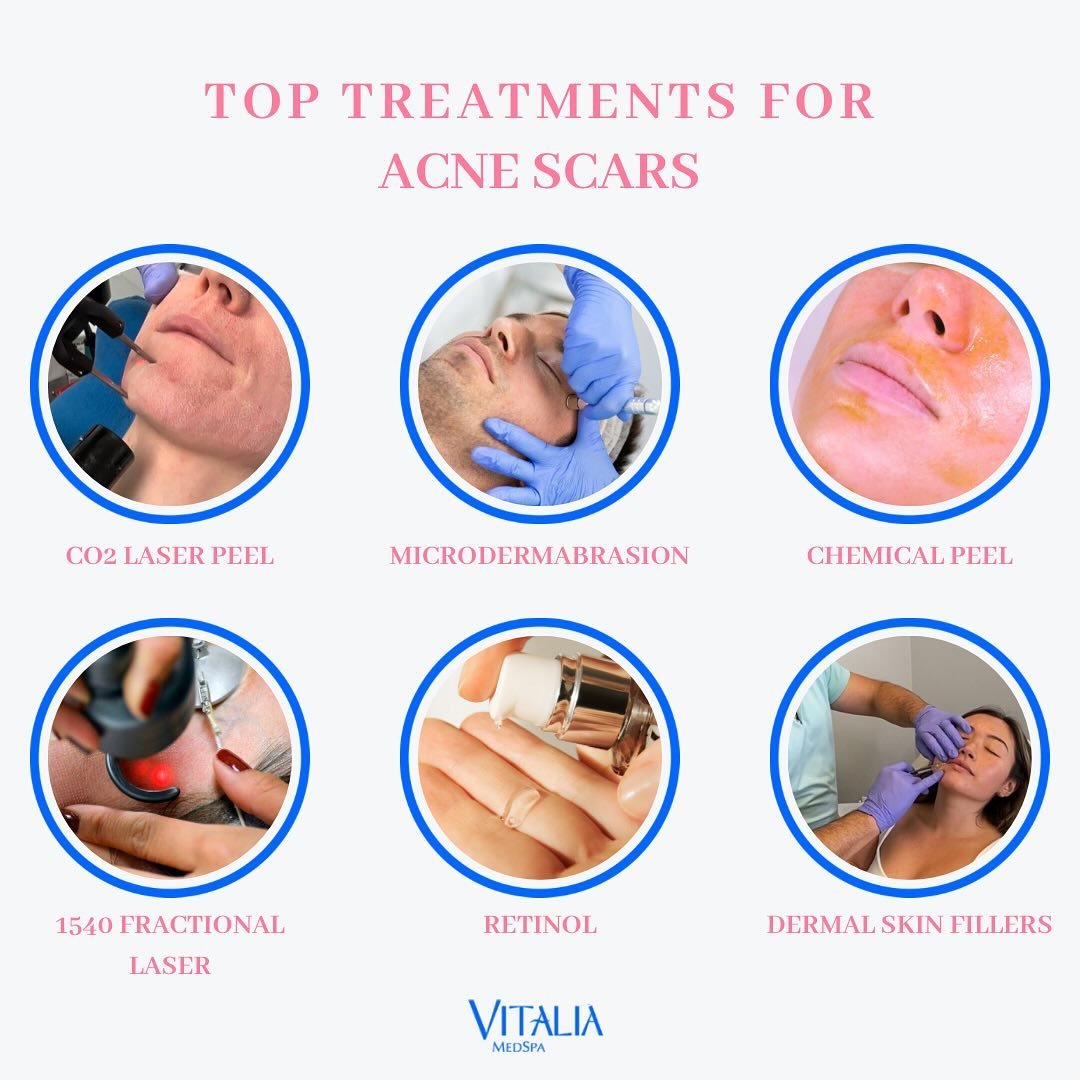 There are several aesthetic treatment options to help erase those stubborn acne scars. From light laser treatments to dermal fillers, Vitalia MedSpa can help you determine which treatment is best for your goals and your wallet. Call and schedule a co