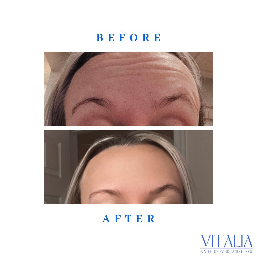 14 day transformation! Botox takes TIME to fully work. Make sure you give yourself a full 14 days before you see the final results and be CONSISTENT with your appointments to get the full preventative effects! You should be touching up your tox every