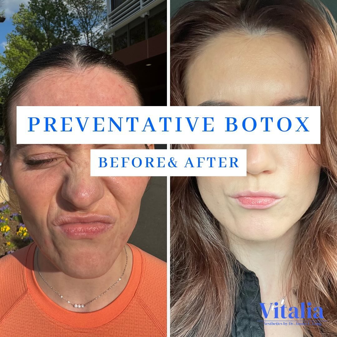 Starting Preventative Botox in your late 20&rsquo;s can be one of the most effective treatments to prolong your youthful appearance and prevent fine lines and deep set wrinkles from developing. The sooner you start, the less you will need and the lon