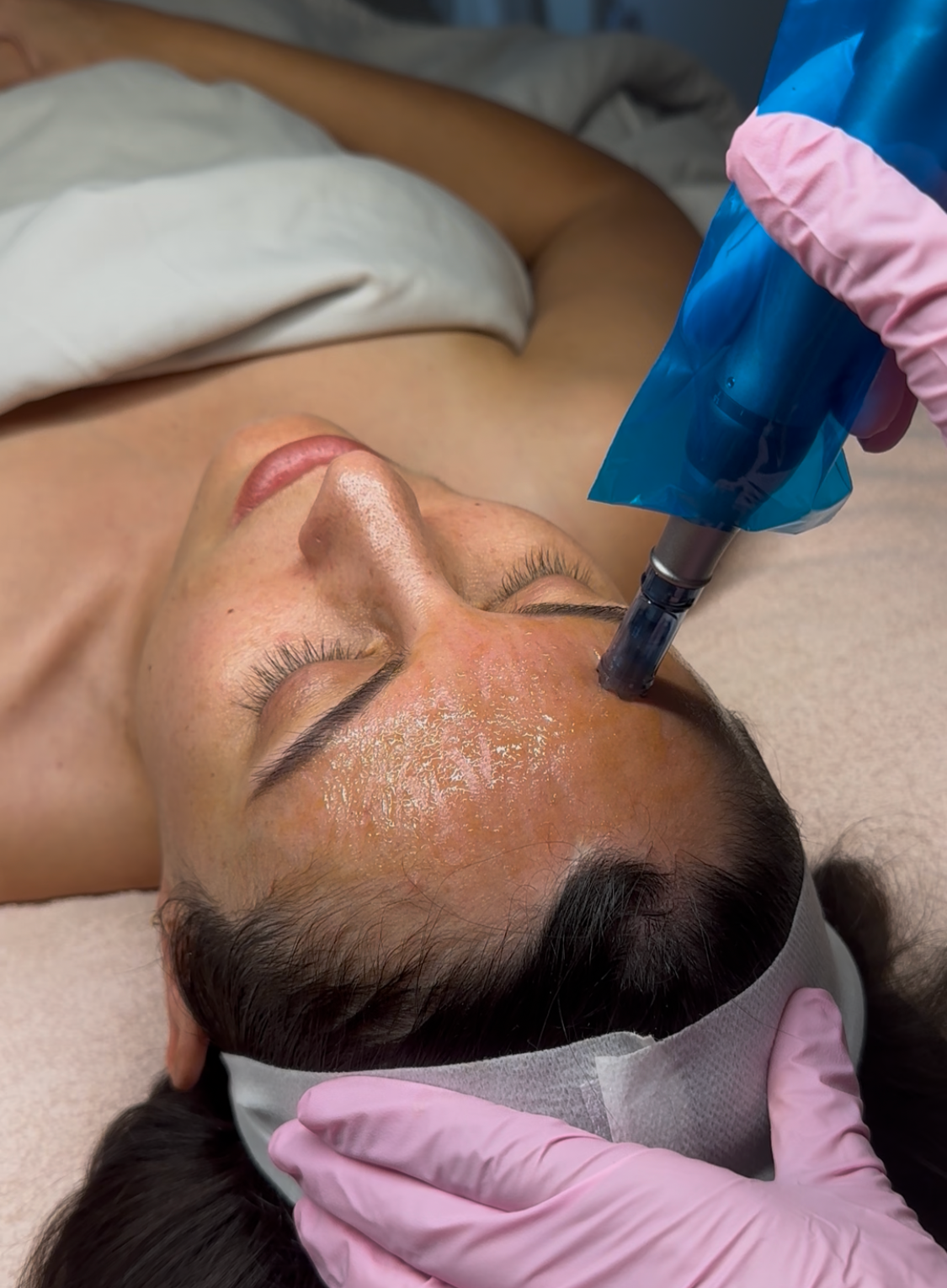 An Upgrade to One of Our Most Loved Treatments: Microchanneling 