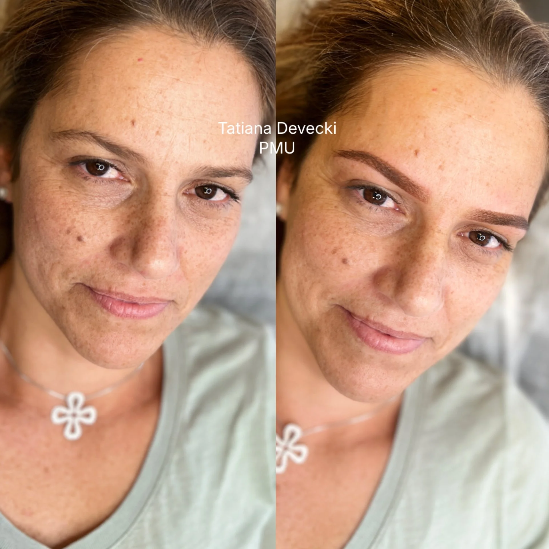 Comparison photo showing a woman's face before and after skin treatment. The left side depicts the woman's skin with freckles, redness, and blemishes, while the right side shows clearer skin with reduced freckles and redness. The woman has brown eyes