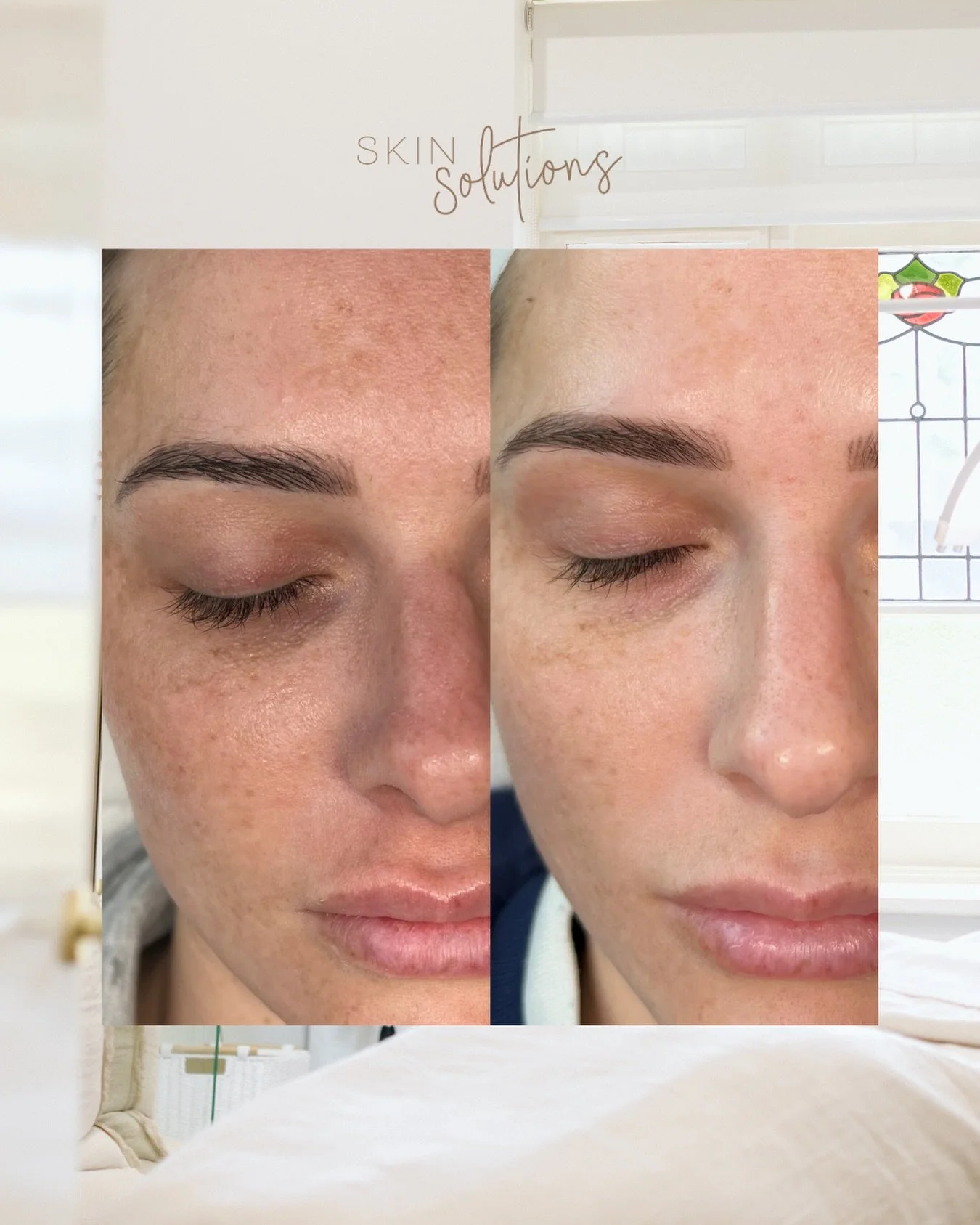 Friday feel good post with another gorgeous skin journey ✨

Consistent level 3 and 4 corrective peels targeting pigmentation combined with a tailored at home skincare routine = RESULTS

Proof that what we ALWAYS say is the key&hellip;consistency cons
