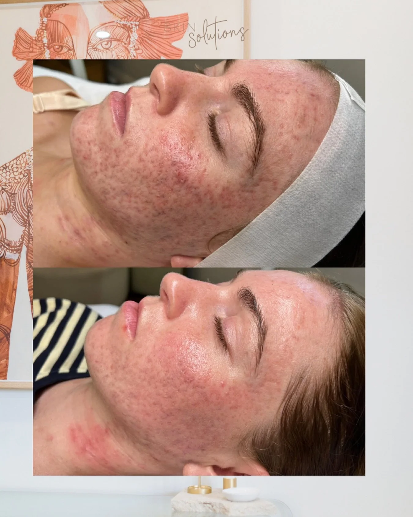 Our Skin Transformation Program is underway, and we are already seeing some incredible progress 🙌🏼😍 

These photos are just one month apart! Achieved with consistent, complete prescribed home care and in clinic ultrafusion treatments ✨ 

We can&rs