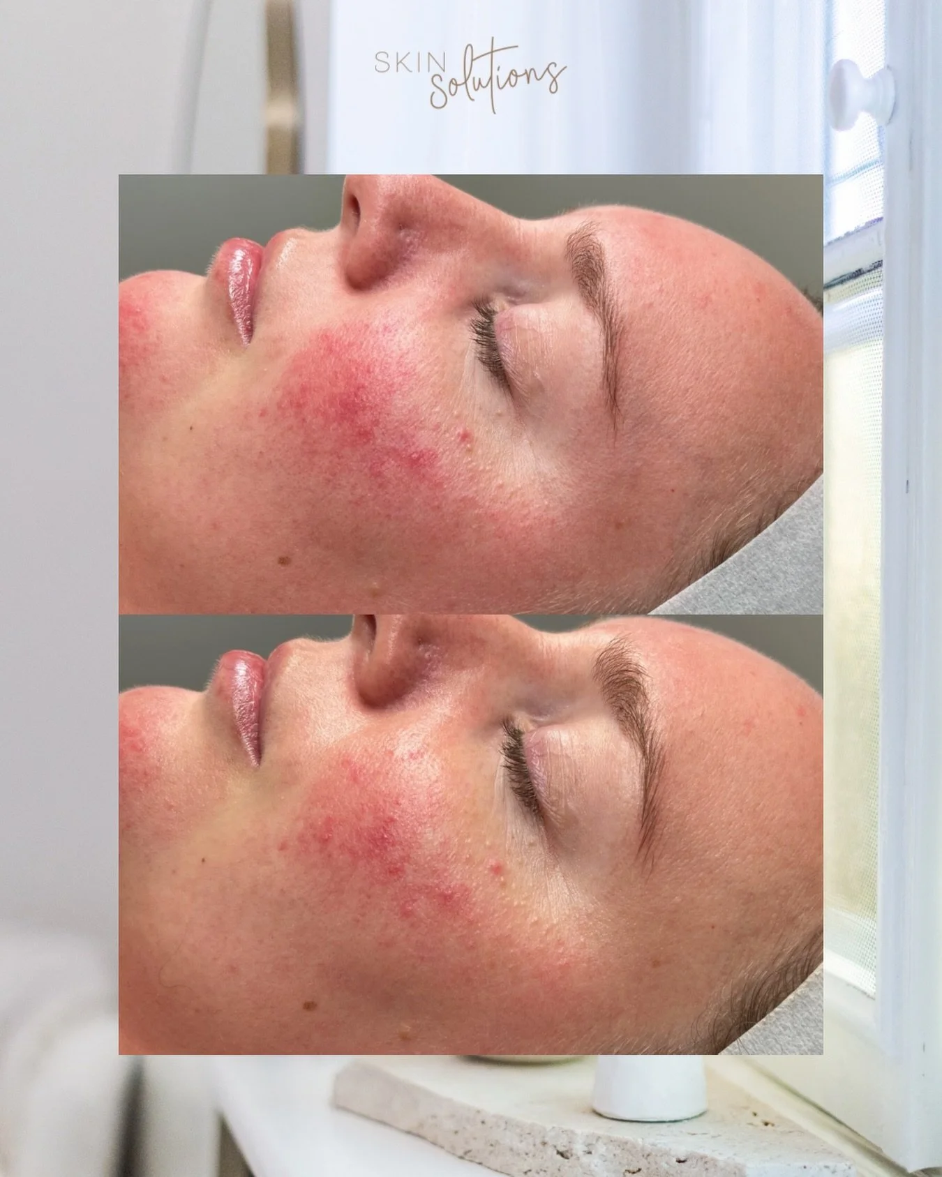 We know true results take consistency and time&hellip;but sometimes we can see a change like this immediately! 😍

This is one of our beautiful Skin Transformation Program clients immediately before and after one treatment of Ultrafusion targeting ro