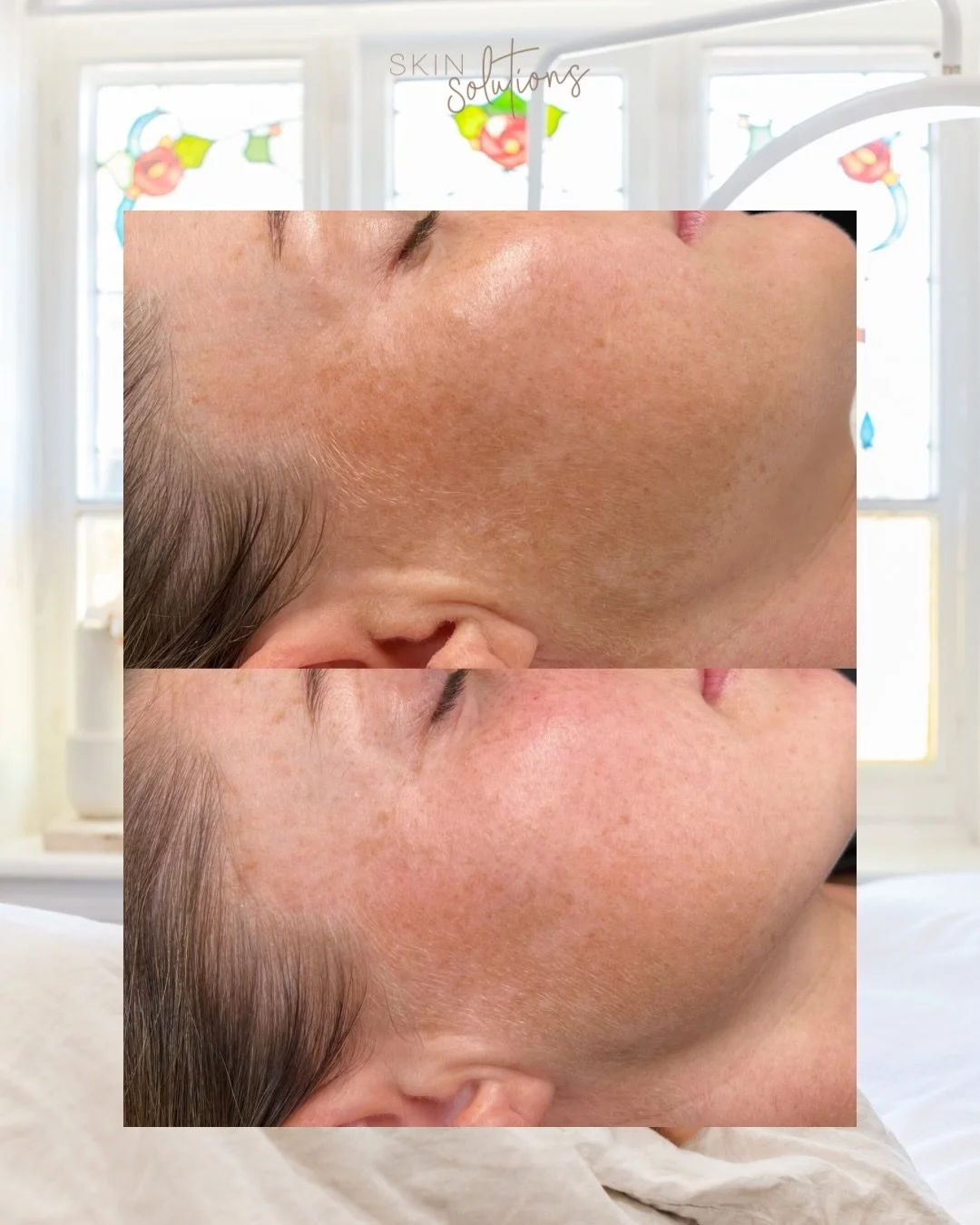 Some more beautiful progress in our Skin Transformation Program 🫶🏼 

For this client we are targeting Melasma, with this progress achieved after just four weeks of consistent at home care with their core Lira products and a Level Two Corrective Pee