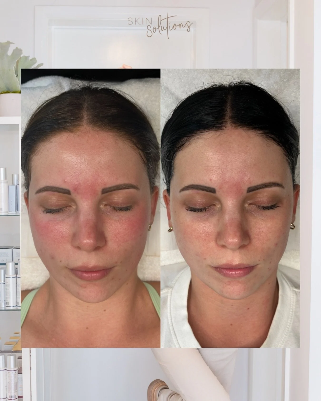 Our Skin Boot Camp&nbsp;is designed for new clients&nbsp;who want to see real results, and here is the proof 🌟💪🏼

Over 12 weeks, you&rsquo;ll follow a tailored, professional skin plan&nbsp;with:

🤎4 targeted in-clinic treatments&nbsp;(one every 3