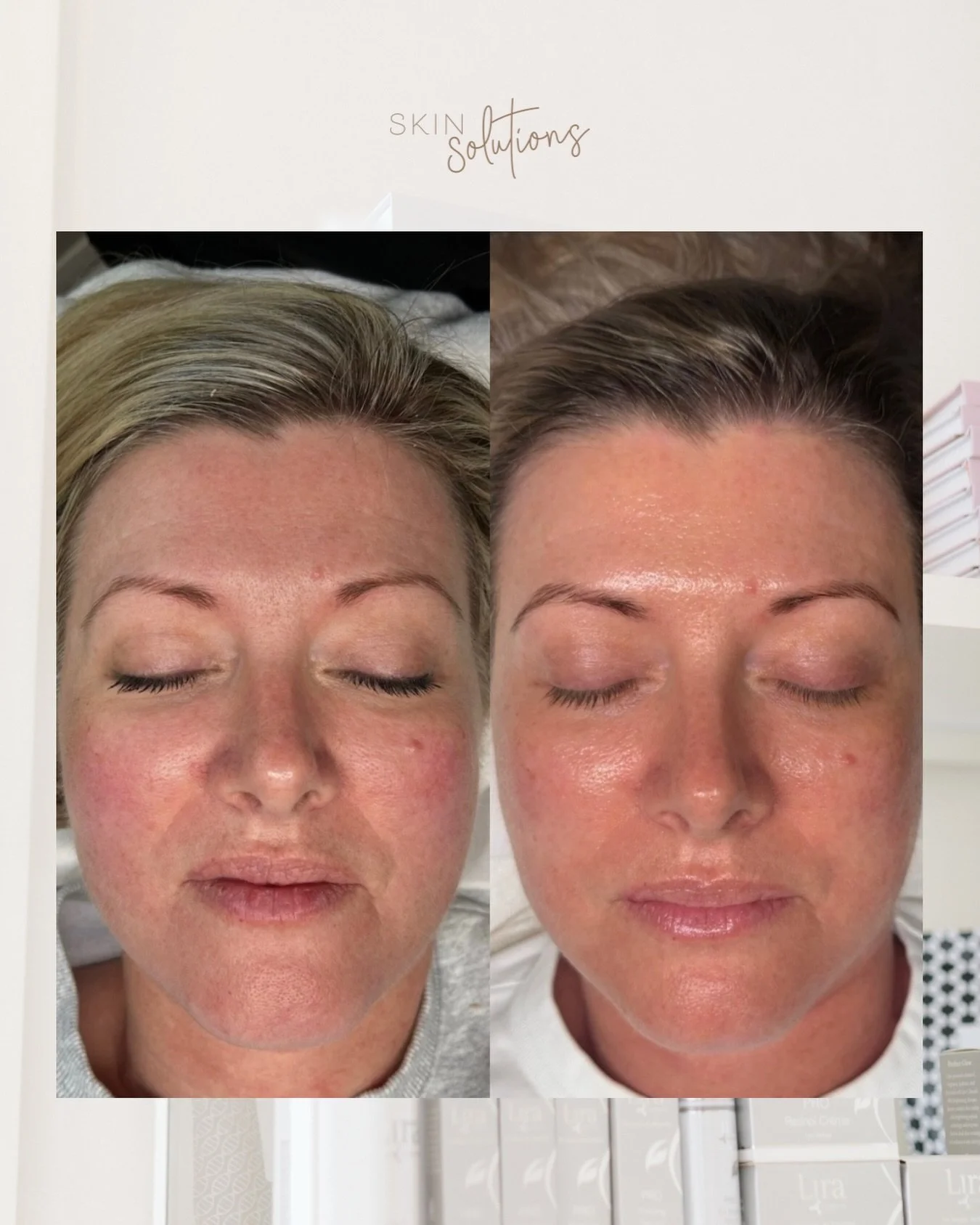 How&rsquo;s the glow 😍😍✨✨

The result of consistency with home care and monthly skin treatments, made easier with our payment plan options. 

All of our Payment Plans include 10% off treatments AND products, with a treatment plan designed and payme