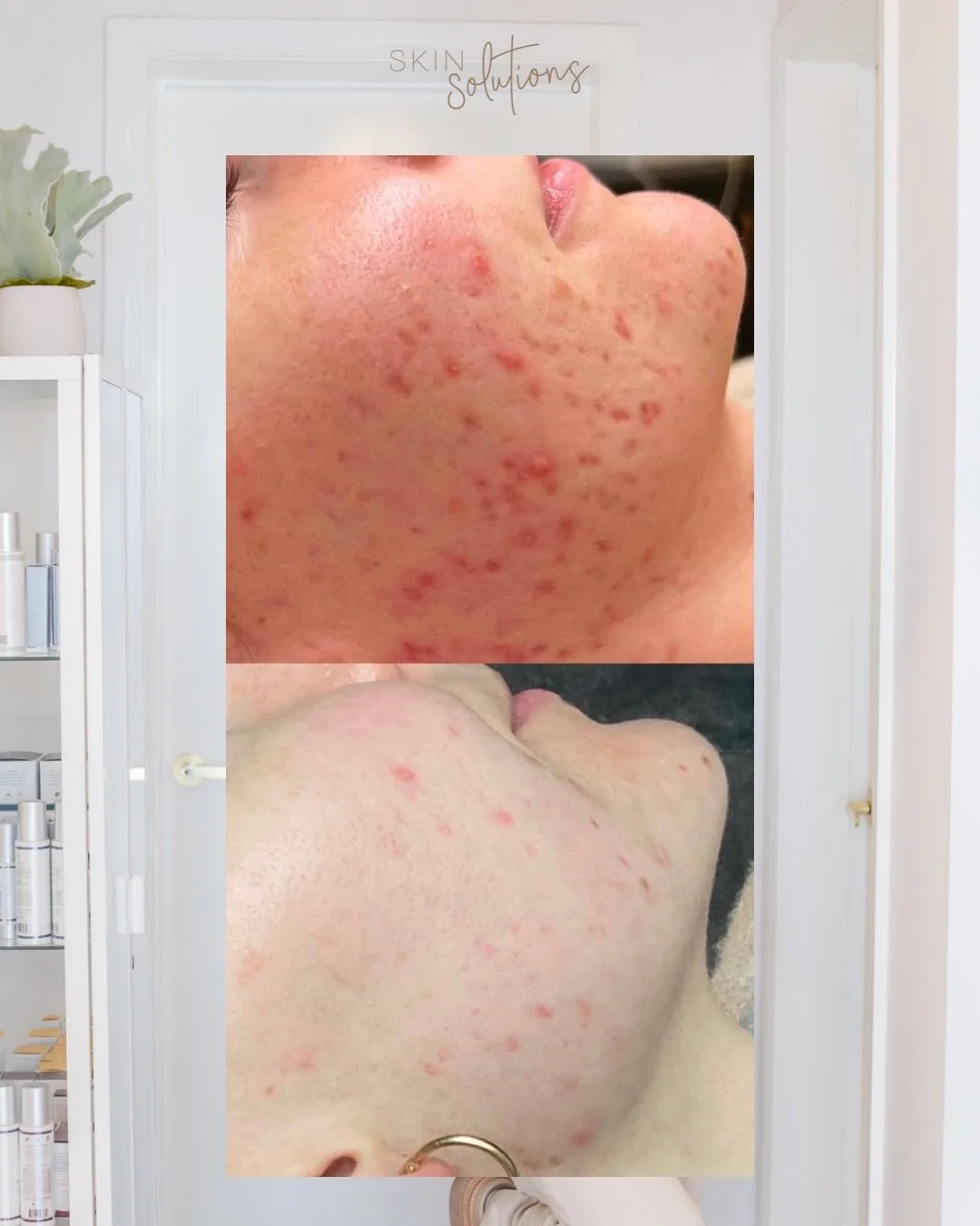There is no one size fits all approach to treating acne, with no two skins the same. 

Treating acne is all about uncovering the root cause, curating the right treatment plan and utilising a tailored skincare regime. 

But most importantly, effective