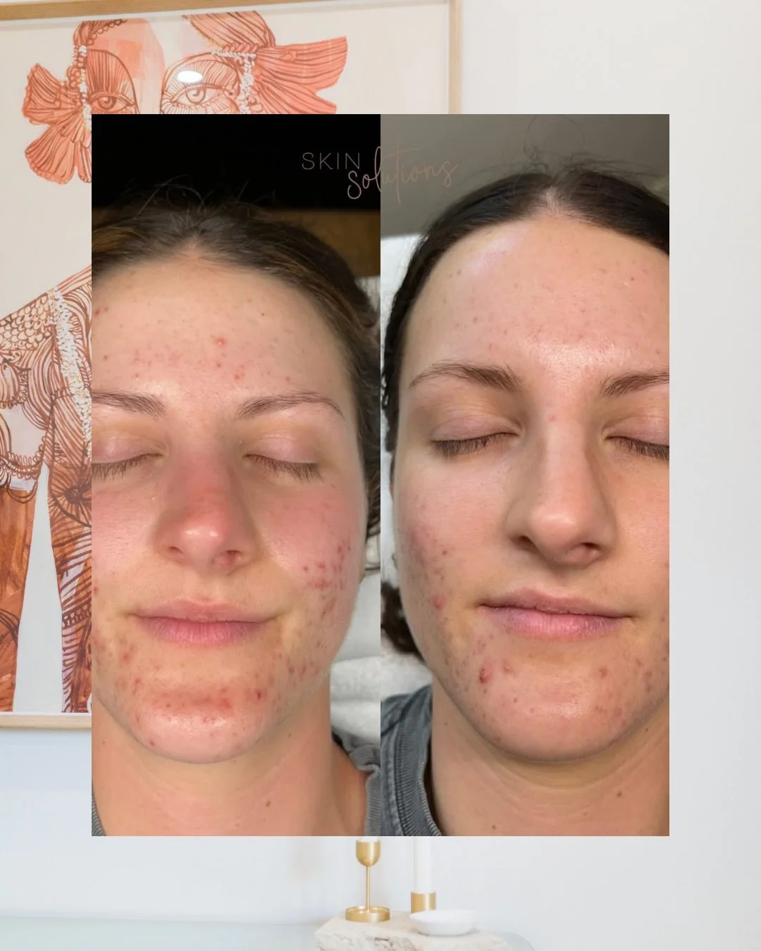 Consistency creates change ✨

Less breakouts. Less inflammation. Less Scarring.

This transformation was after just weeks into a 8 month personalised treatment and payment plan, to make consistent treatments more manageable.

If you are ready to take