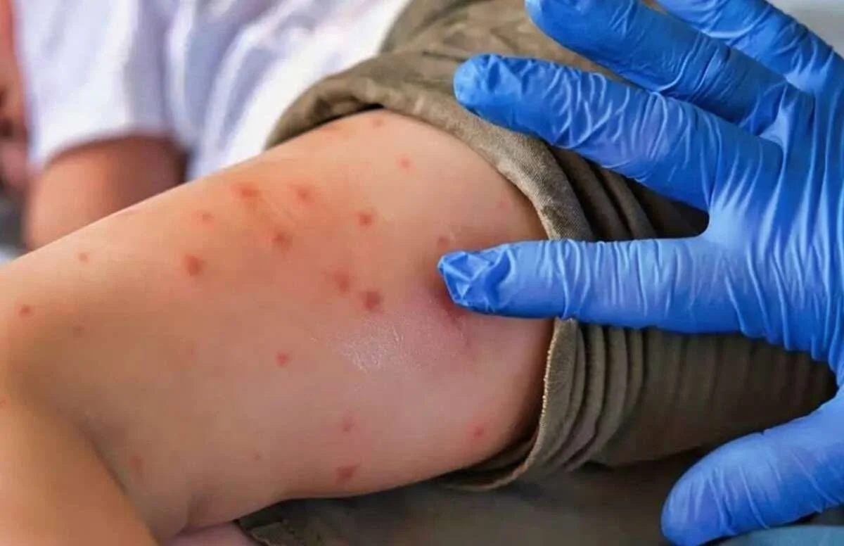 Anuncian ampliación al Programa Nacional de Vacunación contra sarampión, ante el incremento de casos