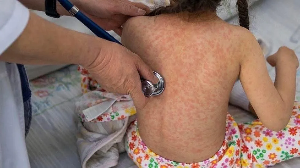 Secretaría de Salud confirma nuevos casos de Sarampión en los municipios de Centro y Tenosique