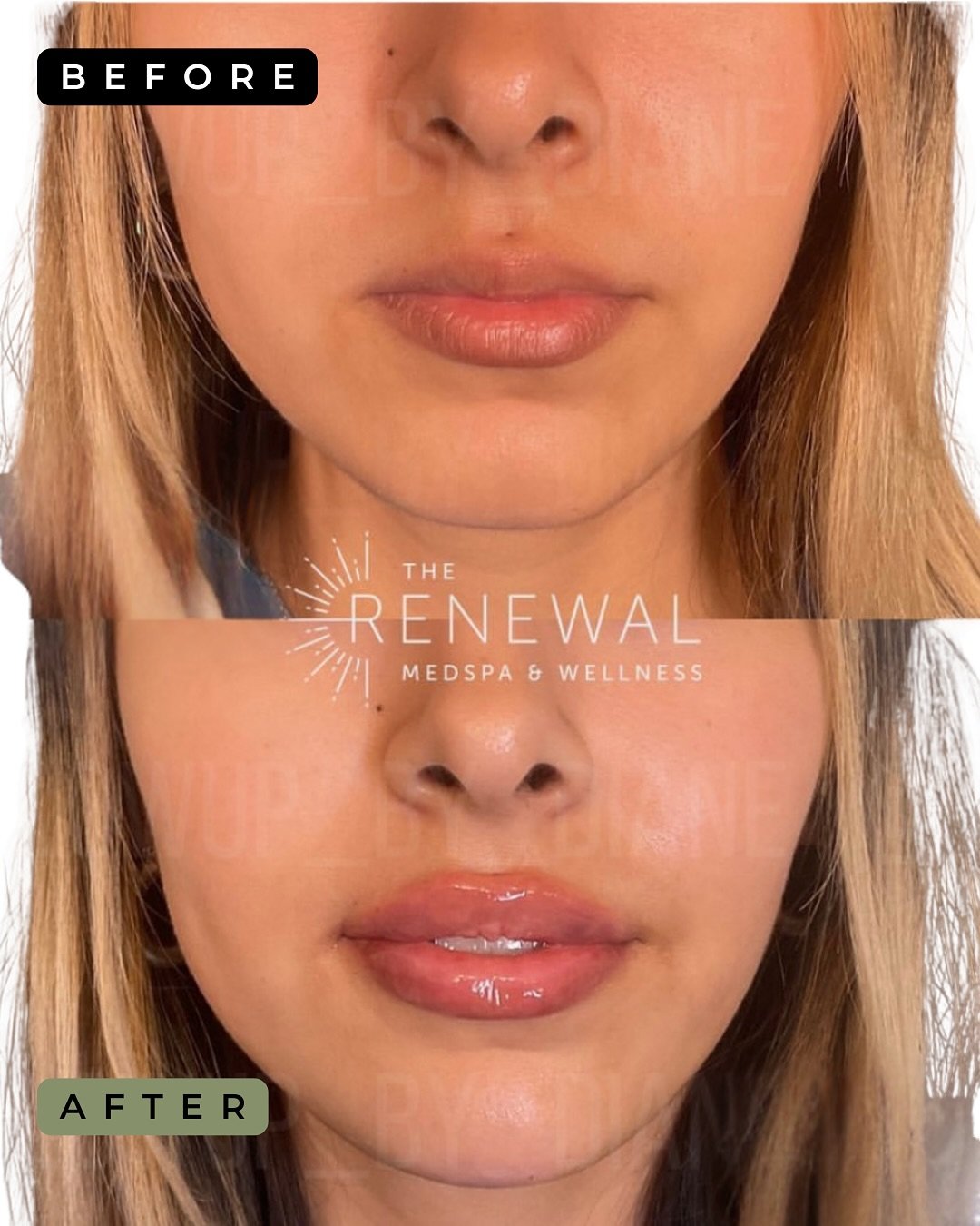 Facial balancing magic ✨
Before &amp; after lip + chin filler 👄💉

This combo treatment is one of our favorites for a reason - adding structure to the chin gives your lips the perfect platform, evens out asymmetries, enhances the side profile, and b