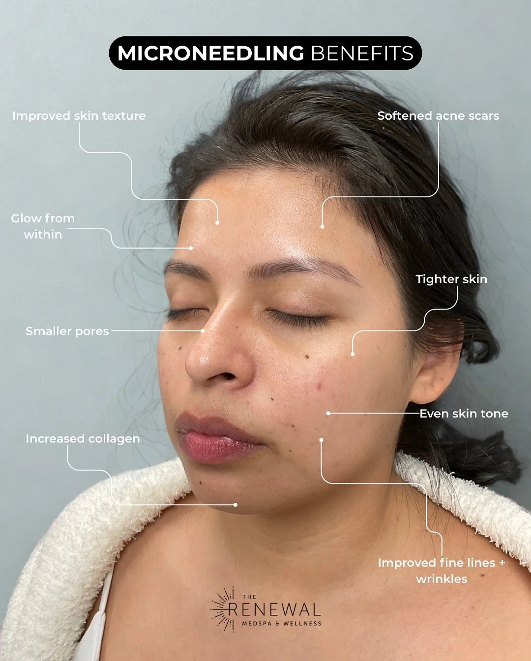 ✨ From texture to tone, the glow is real ✨
After just 3 microneedling sessions, this beauty&rsquo;s skin is smoother, brighter, and more even - with softer acne scars and pores that are barely noticeable.

Microneedling works by boosting collagen + e
