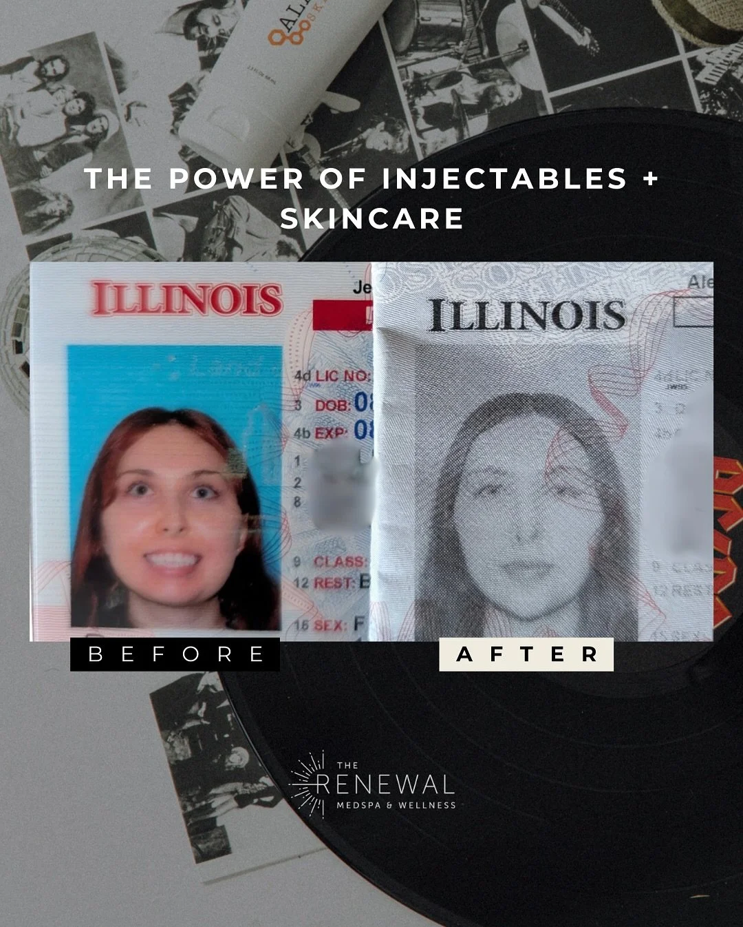 When your license photo ages backwards ⏳➡️✨

This glow-up wasn&rsquo;t an accident - it&rsquo;s the result of a customized plan:
💉 Facial filler for balanced features
🧬 PRP + PDGF under eyes for collagen &amp; brightness
🌟 Quarterly full face tox 